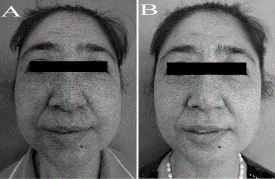 Application of recombinant bovine basic fibroblast growth factor gel in repairing acne rosacea skin lesion