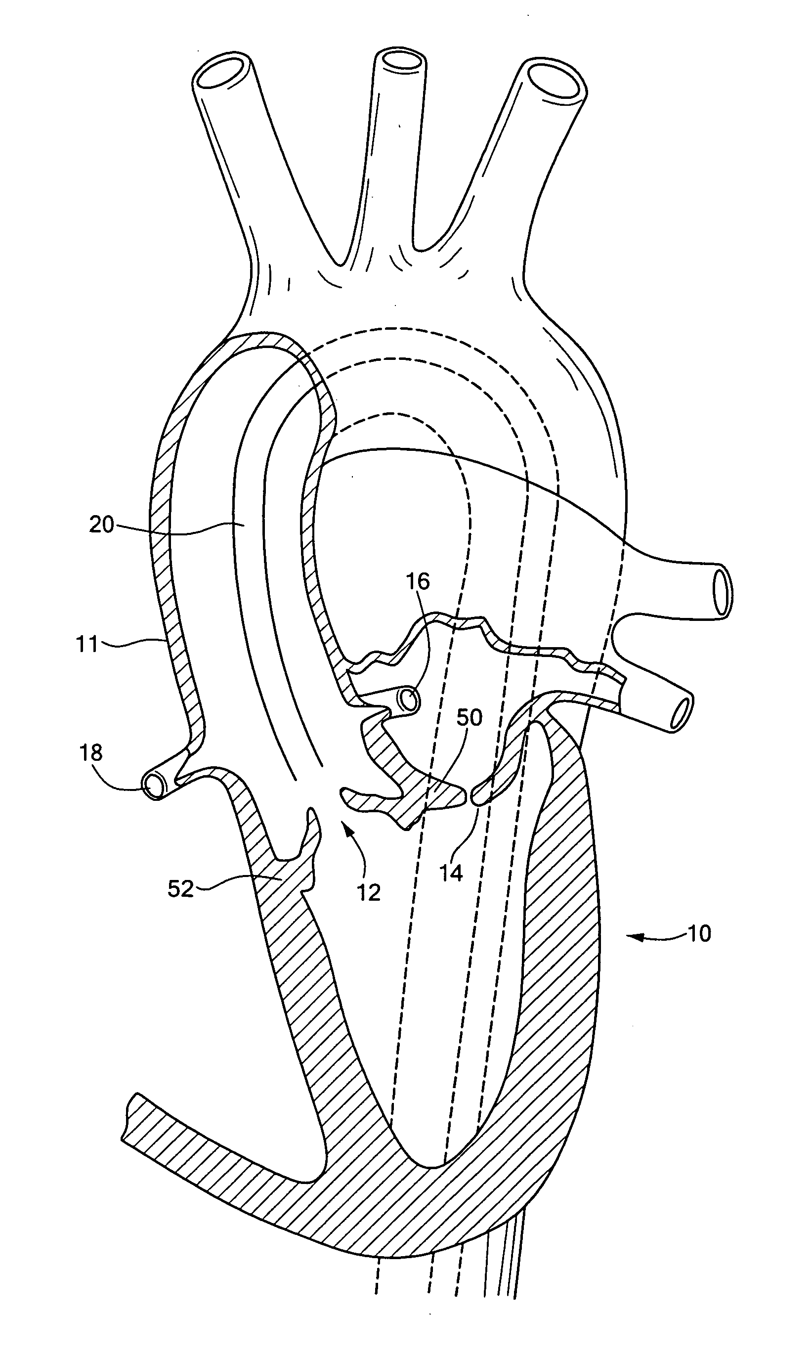 Endovascular tissue removal device