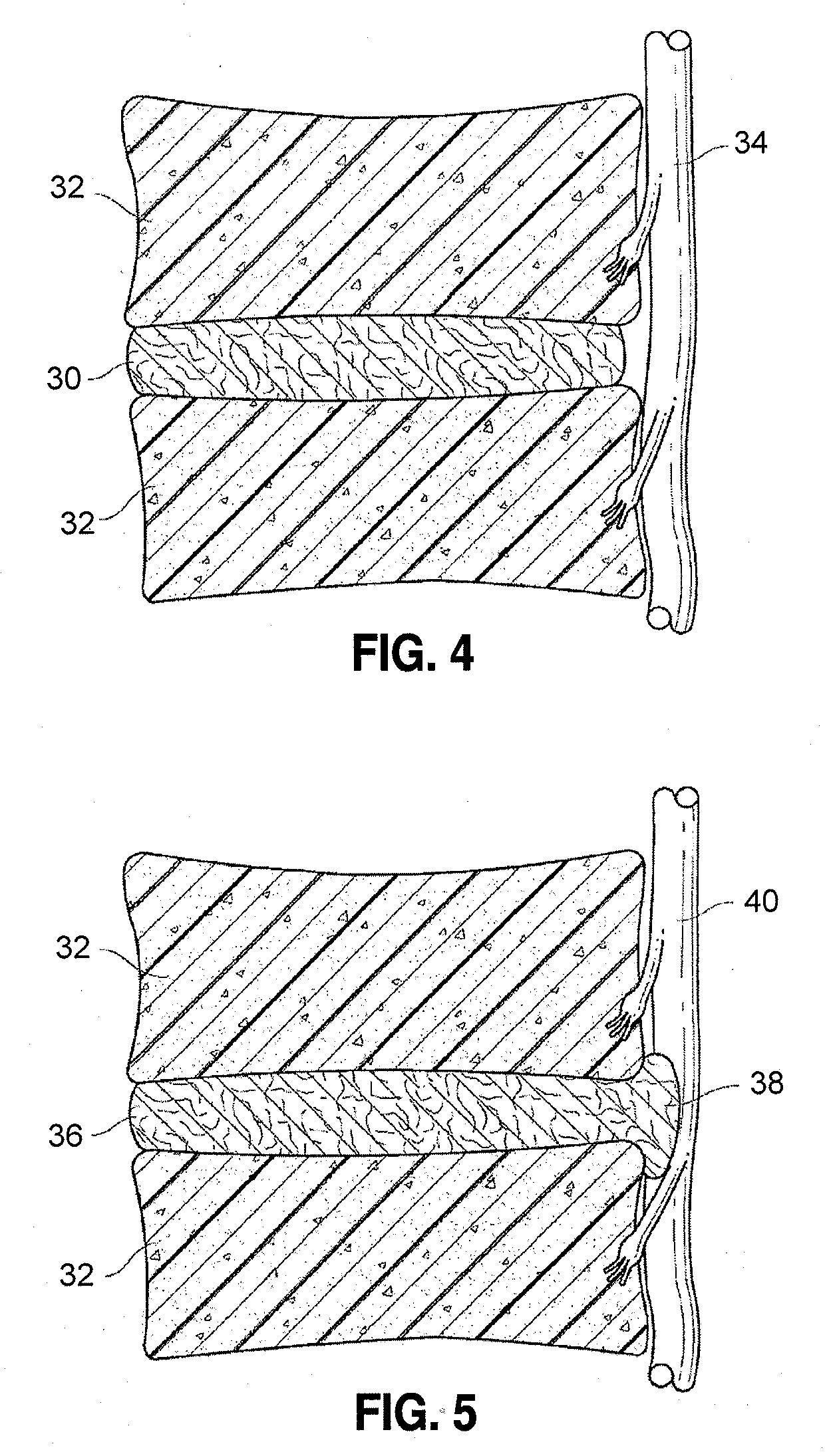Spinal implants and methods