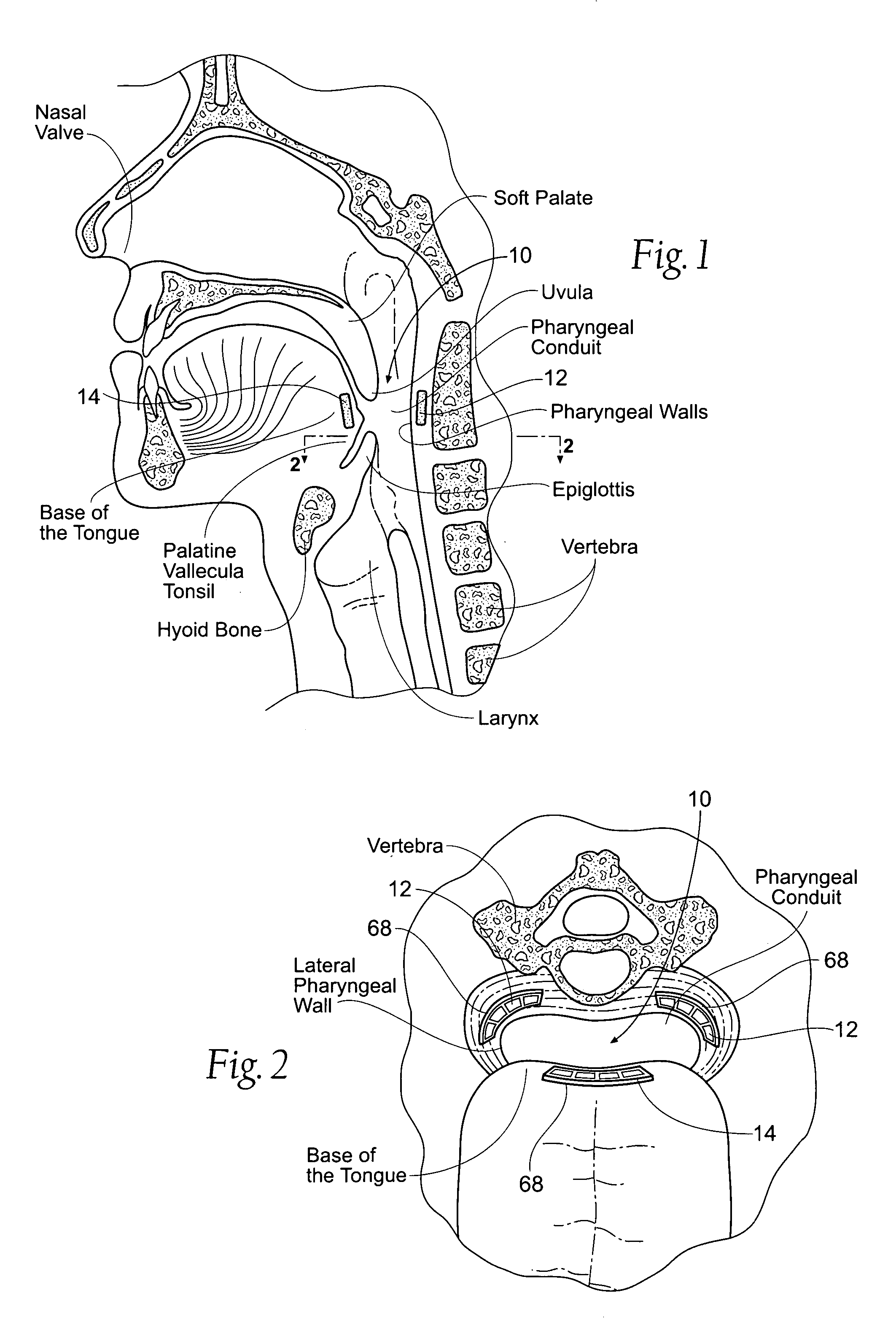 Devices, systems, and methods to fixate tissue within the regions of body, such as the pharyngeal conduit