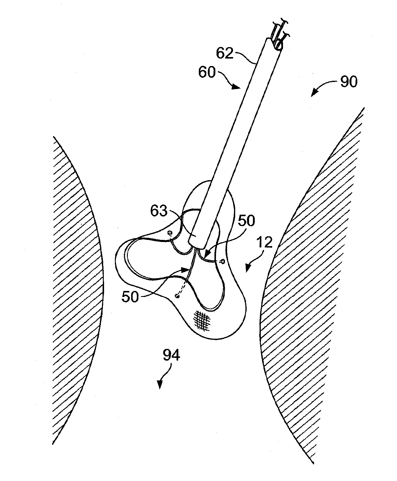 Multiple component prosthetic heart valve assemblies and apparatus for delivering them