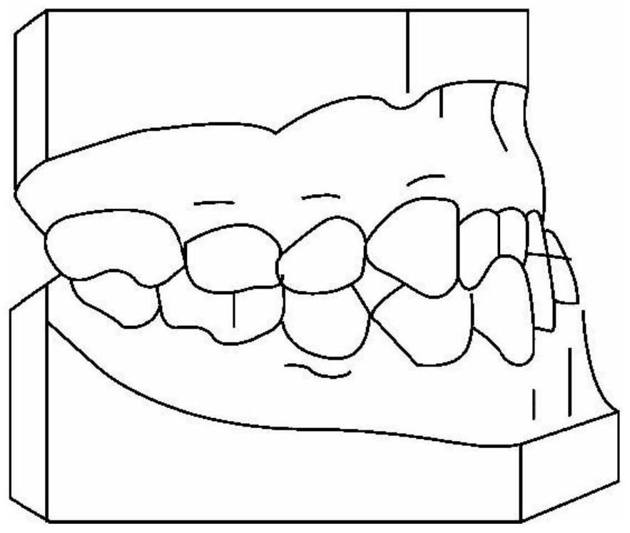 Digital orthodontic method for Angle III-type malocclusion