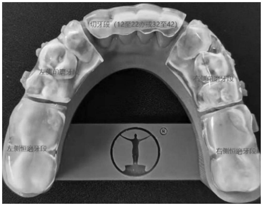 Digital orthodontic method for Angle III-type malocclusion