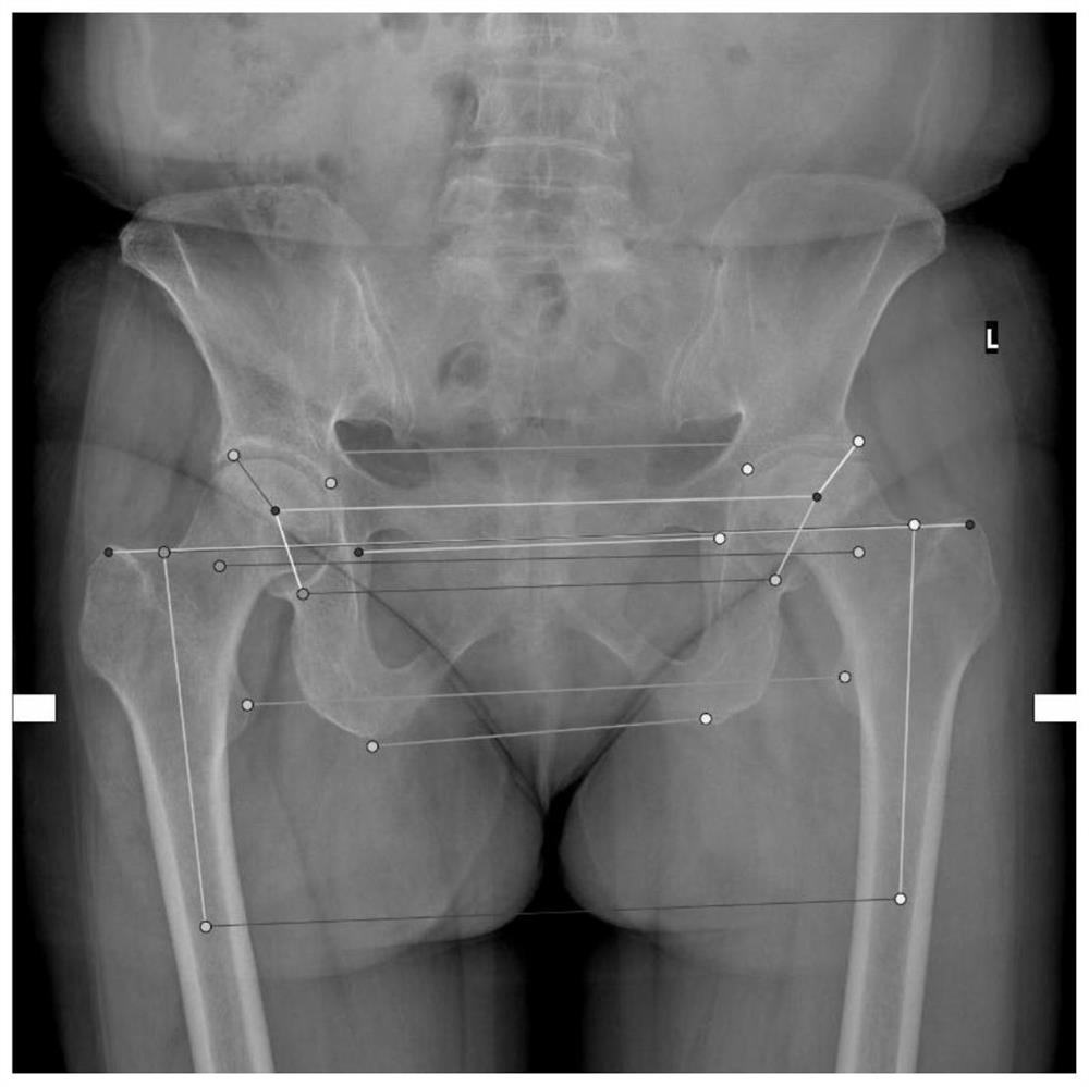 Artificial hip joint prosthesis type matching method and system