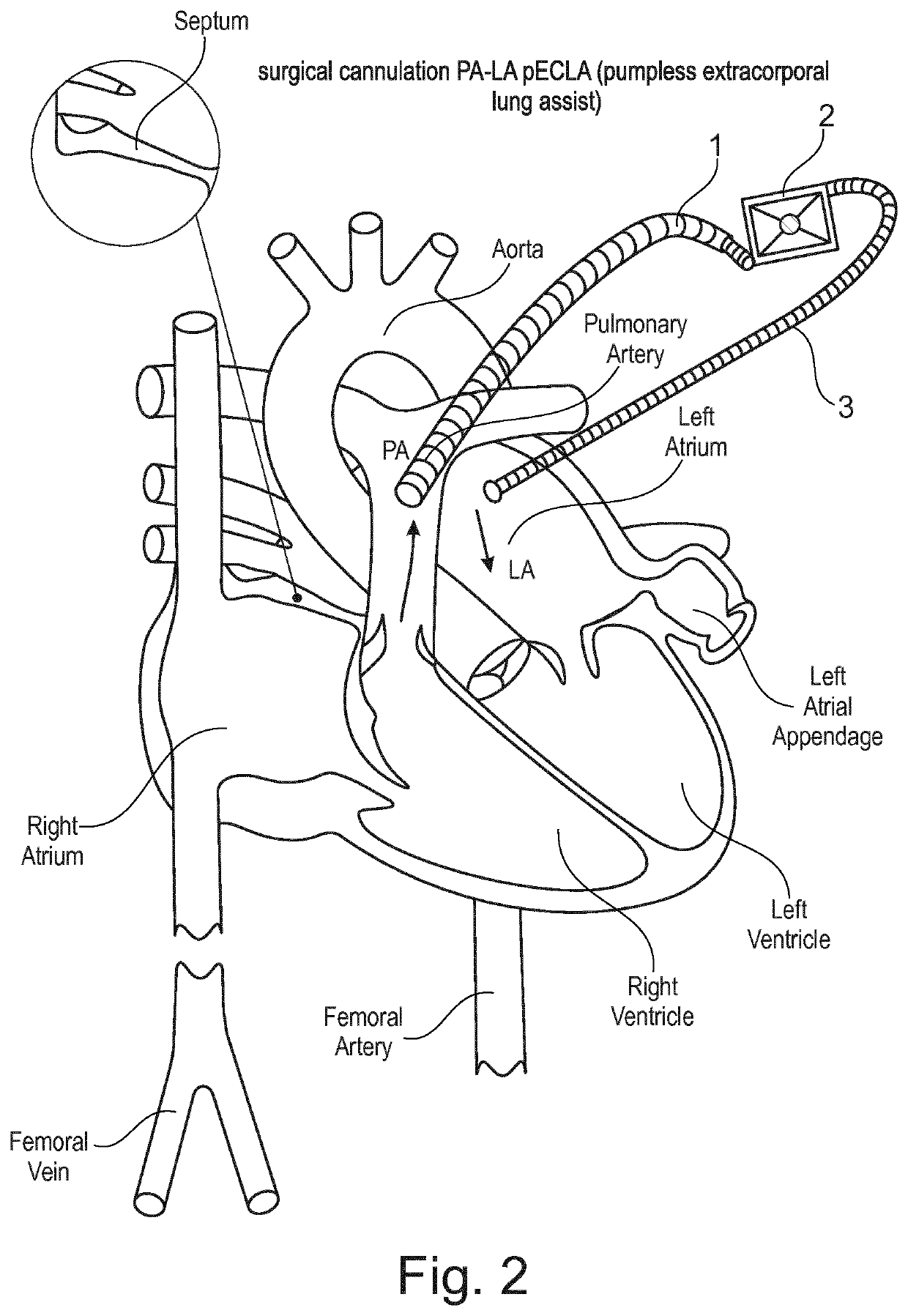 Devices for percutaneous pa-la cannulation and methods of delivering and using the same