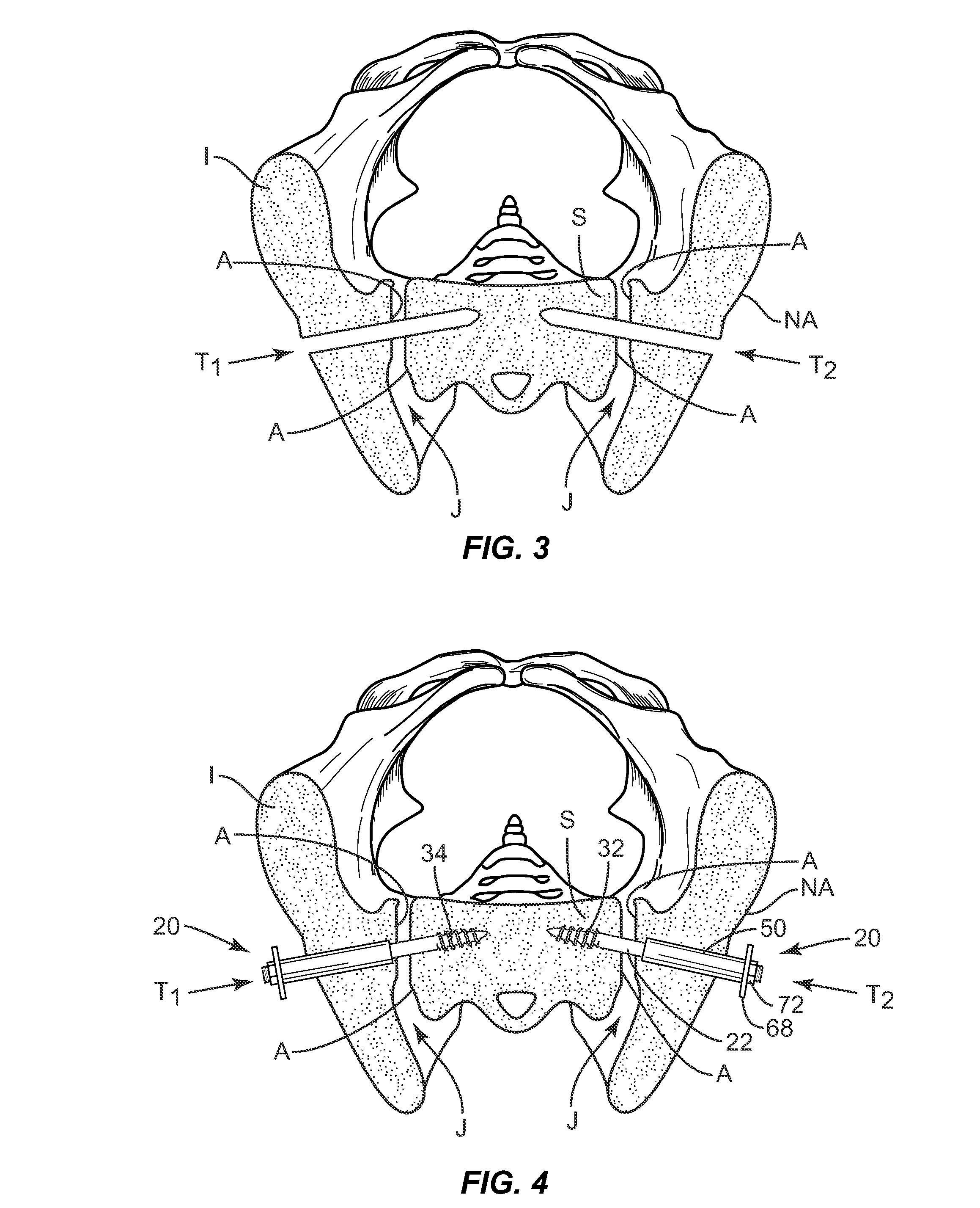 Implant system and method for stabilization of a sacro-iliac joint