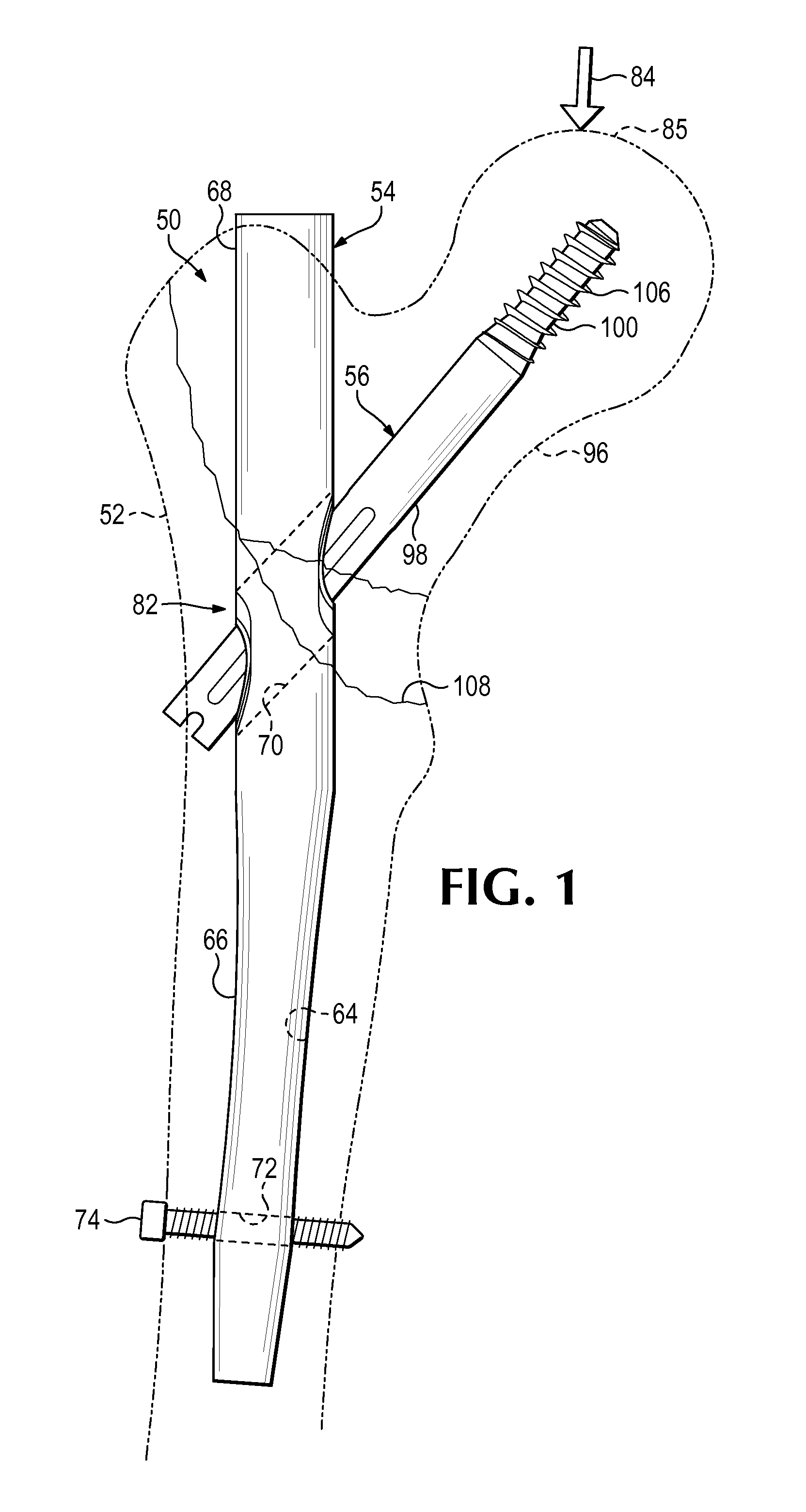 Nail-based compliant hip fixation system