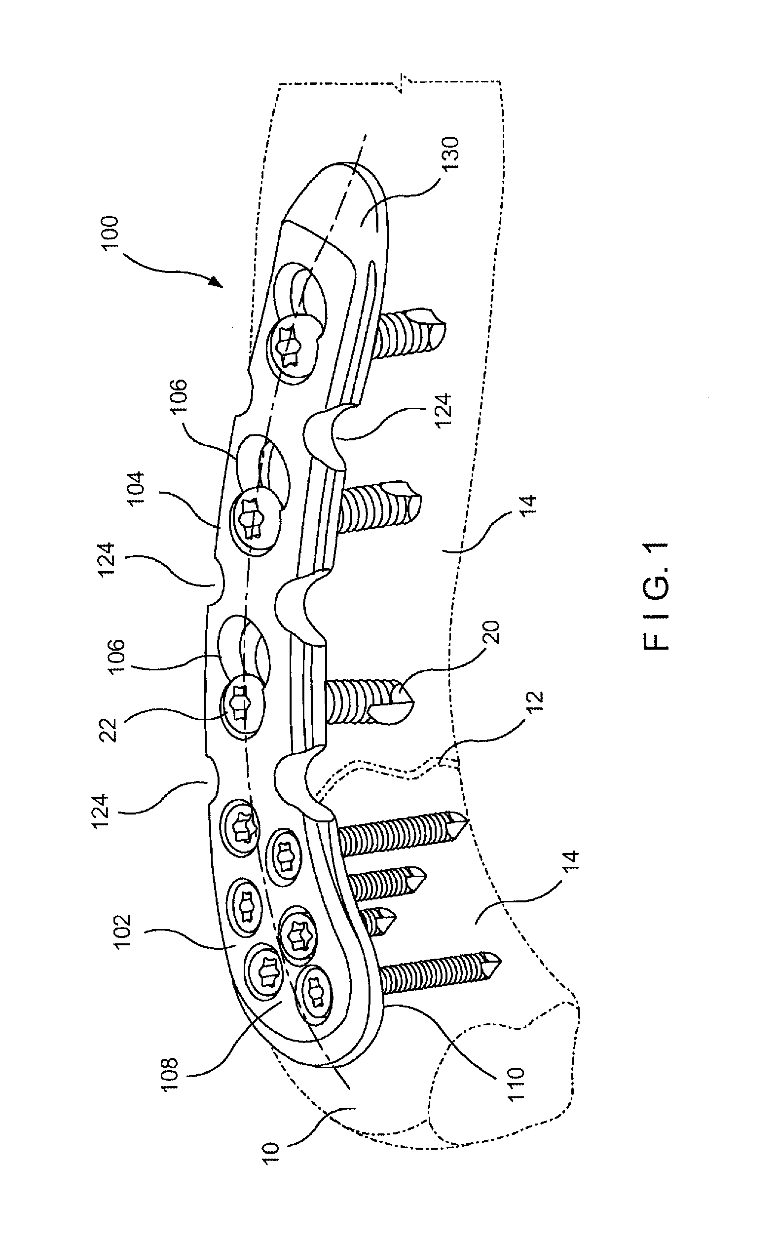 System and method for minimally invasive clavicle plate application
