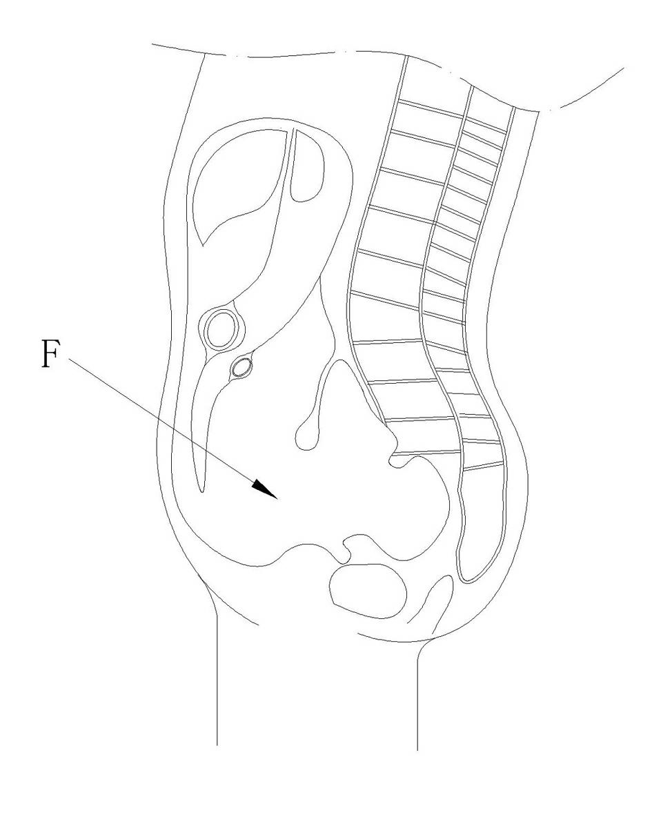 Peritoneal dialysis catheter positioning and adjusting device