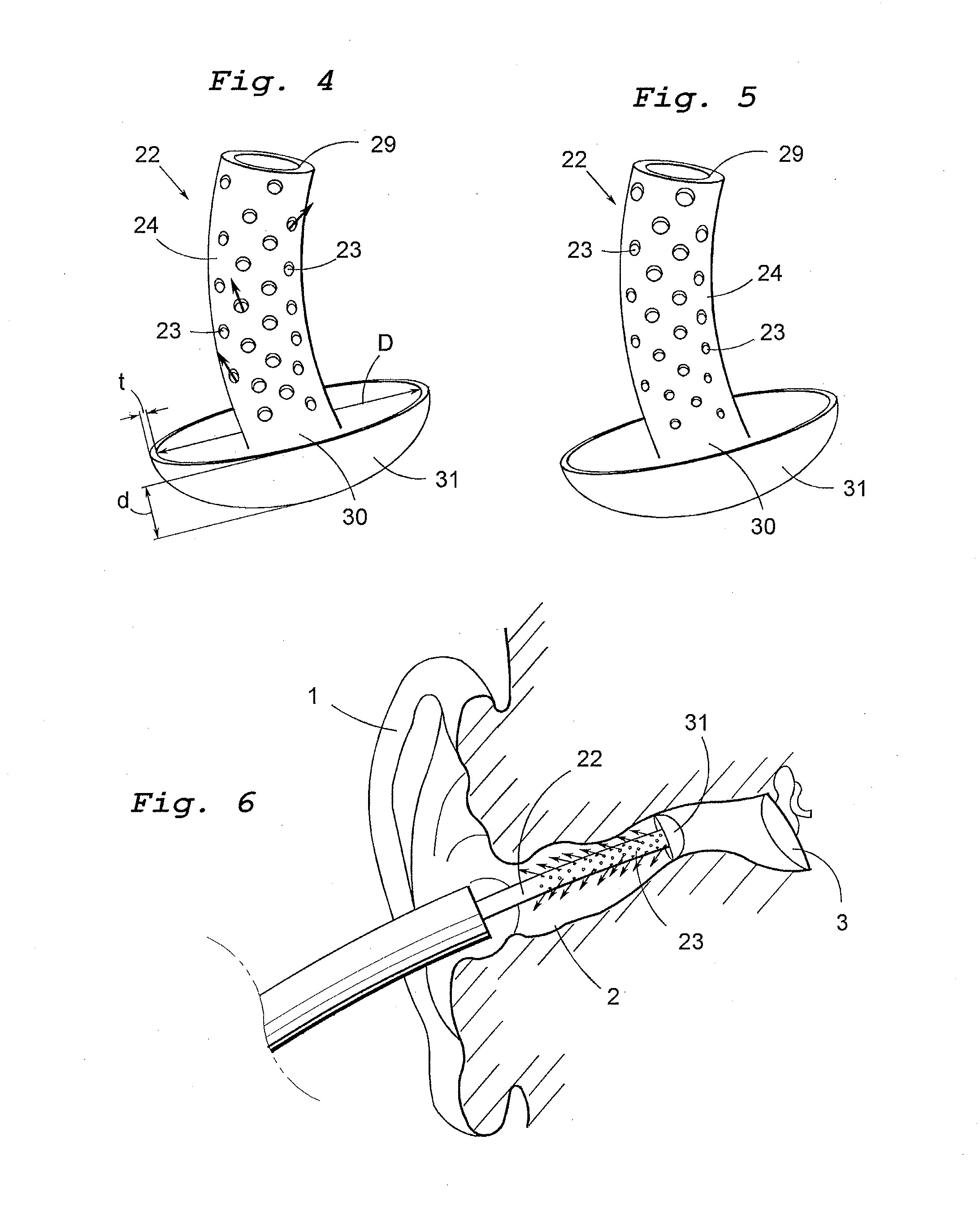 Device for taking impression of an ear