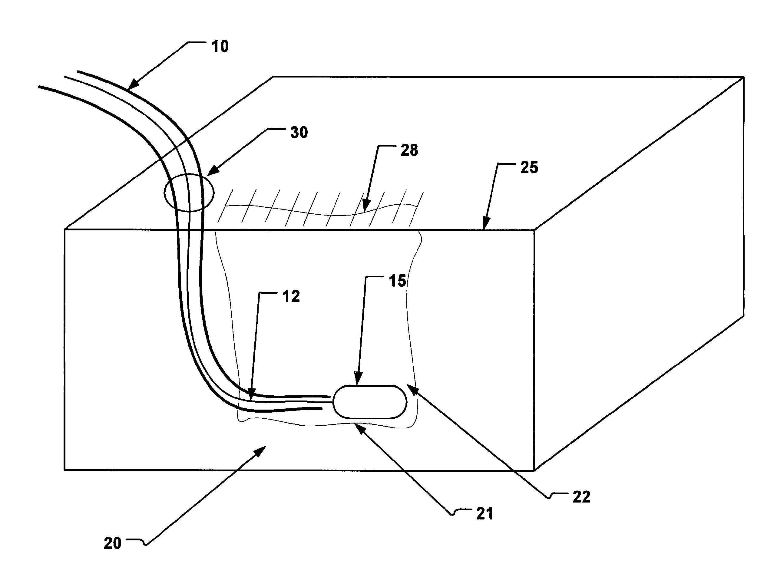 Post Operative Wound Support Device