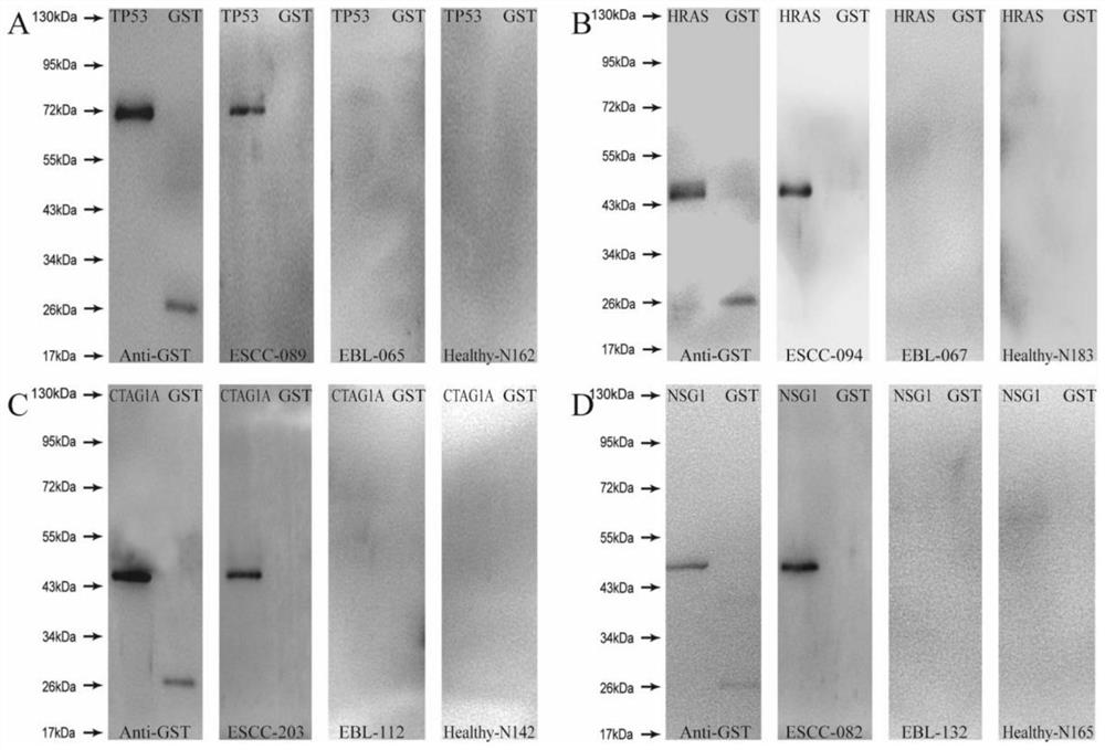 A combined detection kit and application of four autoantibodies for diagnosing early esophageal squamous cell carcinoma