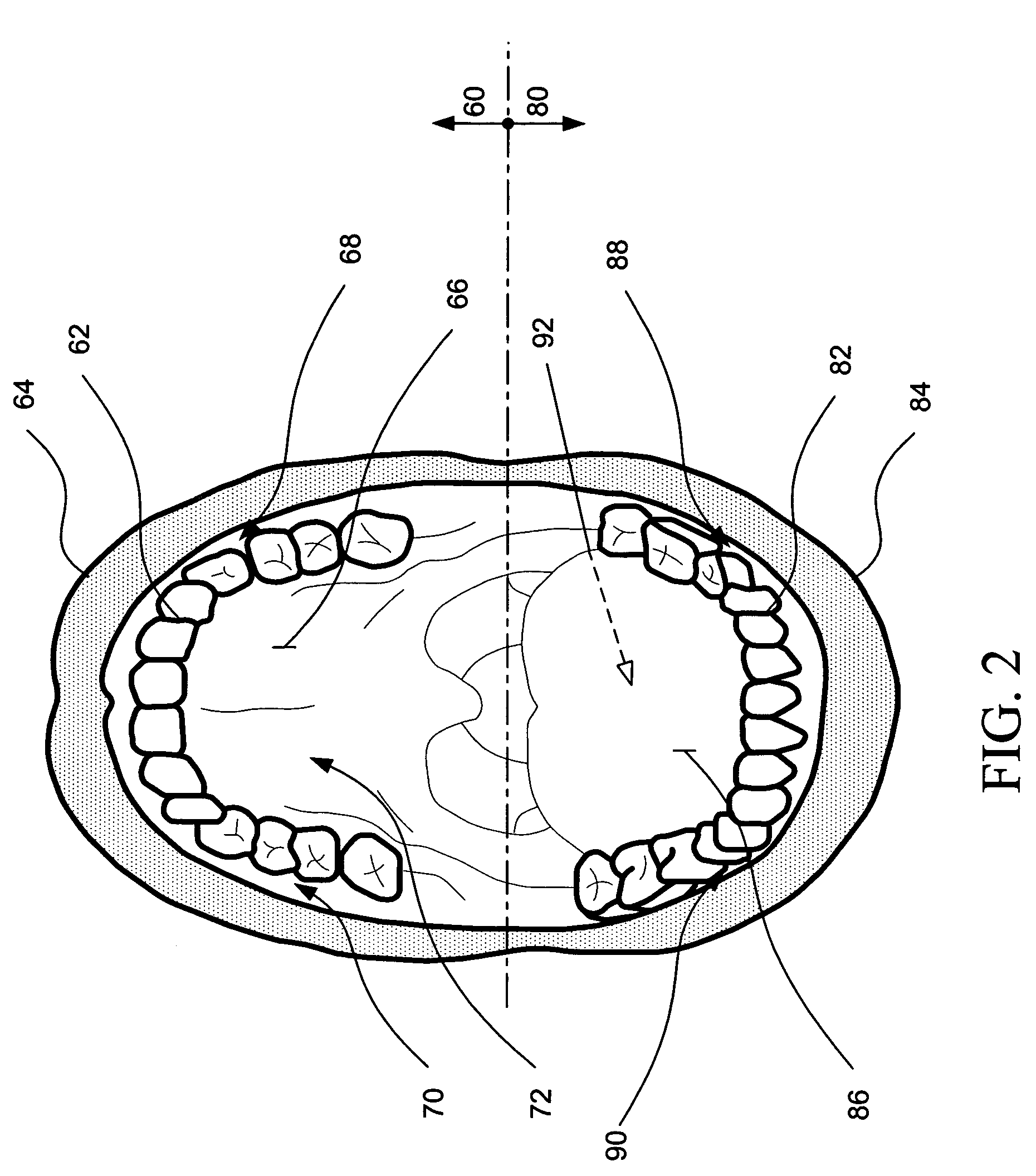 Intraoral aversion devices and methods