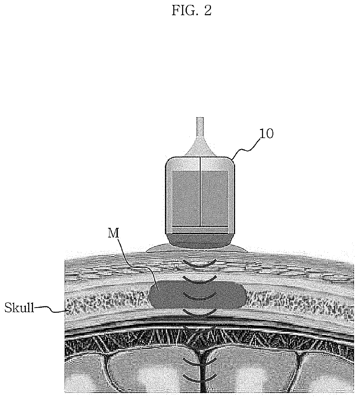 Non-invasive treatment system using intermedium