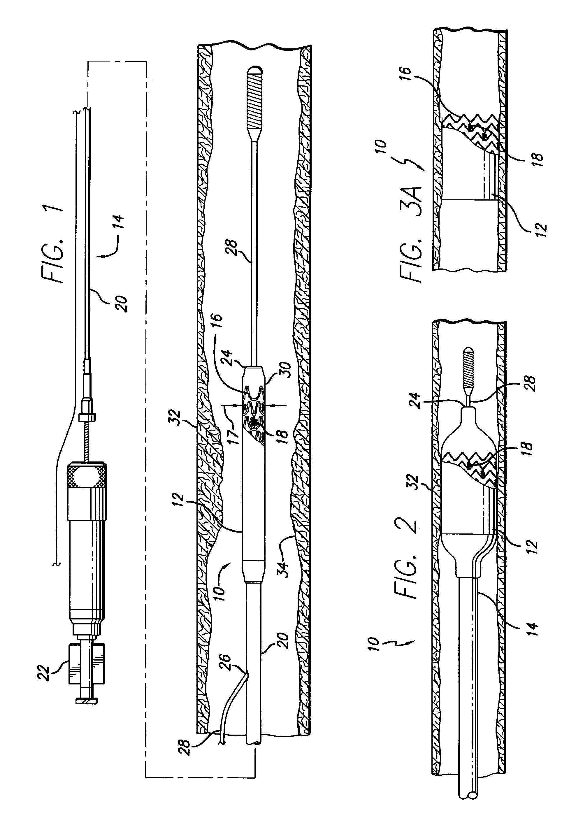 Drug-eluting stent cover and method of use