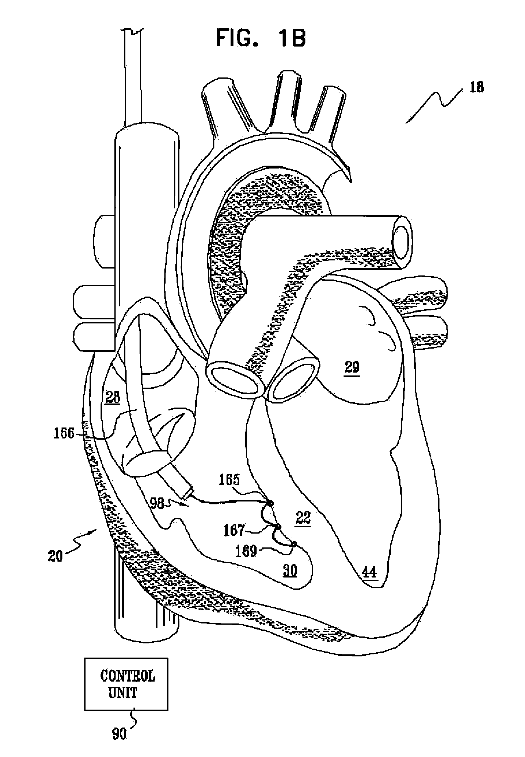 Signal Delivery Through The Right Ventricular Septum