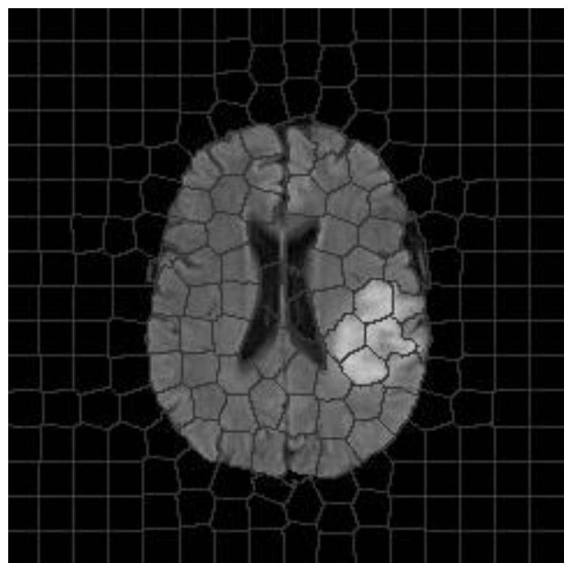 A method for automatic segmentation of brain tumor images based on superpixel fuzzy spectral clustering