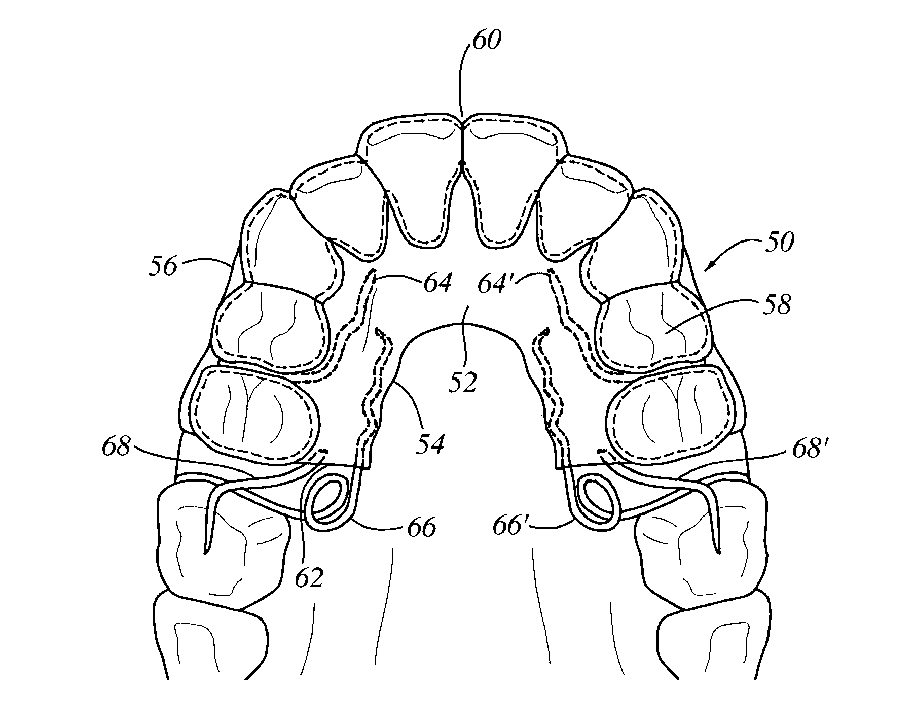 Orthodontic appliance with embedded wire for moving teeth
