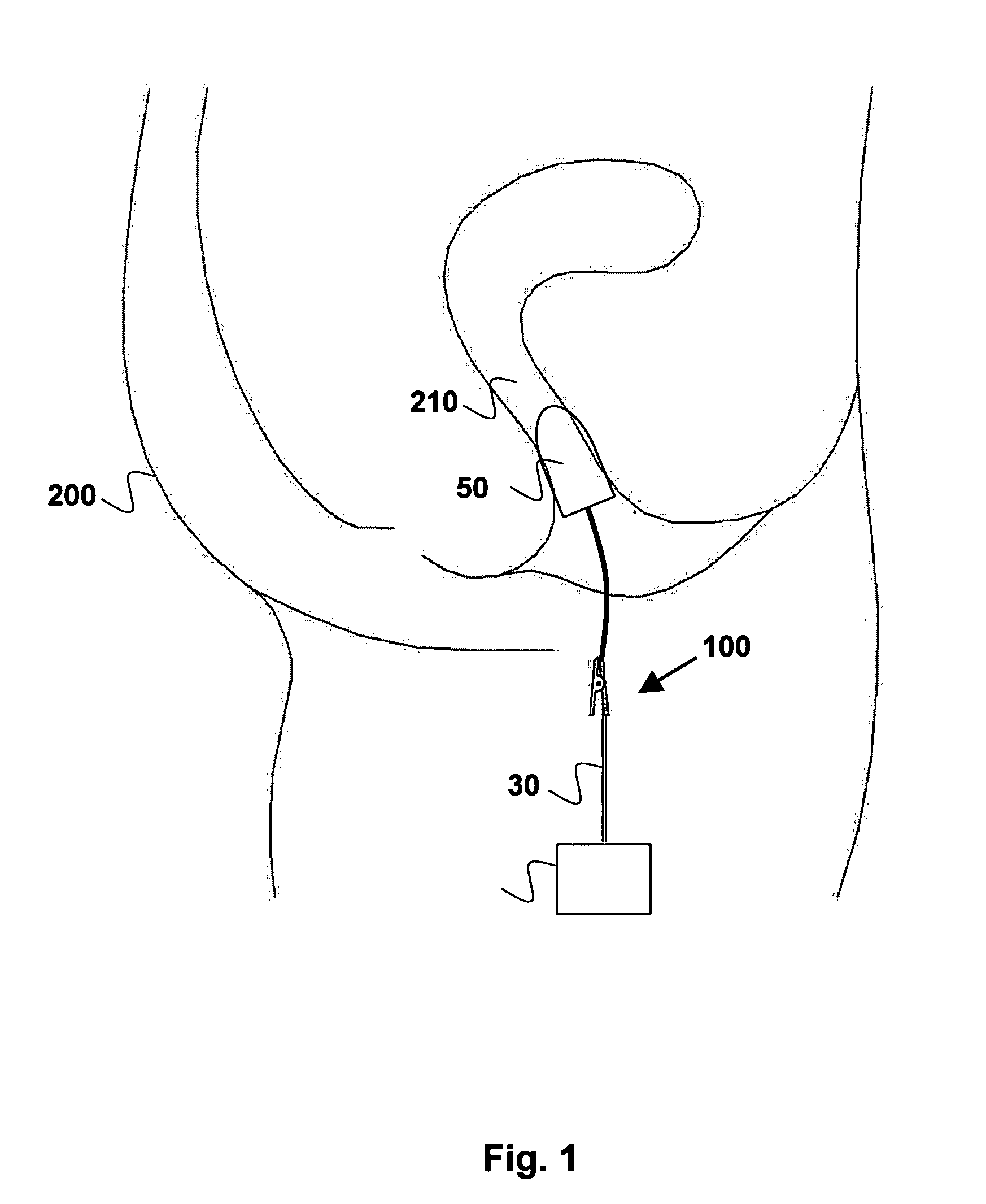 Method and apparatus for exercising pelvic floor muscles