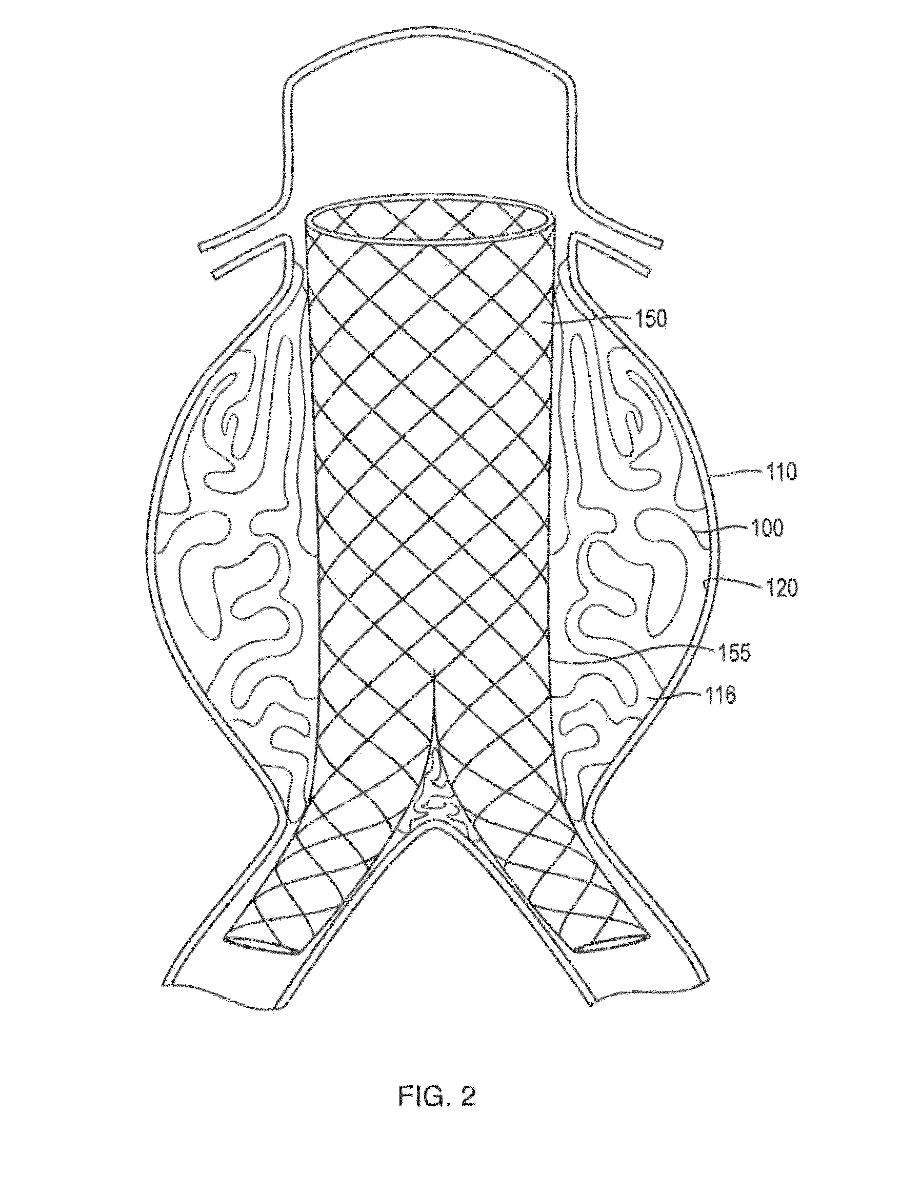 In-situ forming foams with outer layer