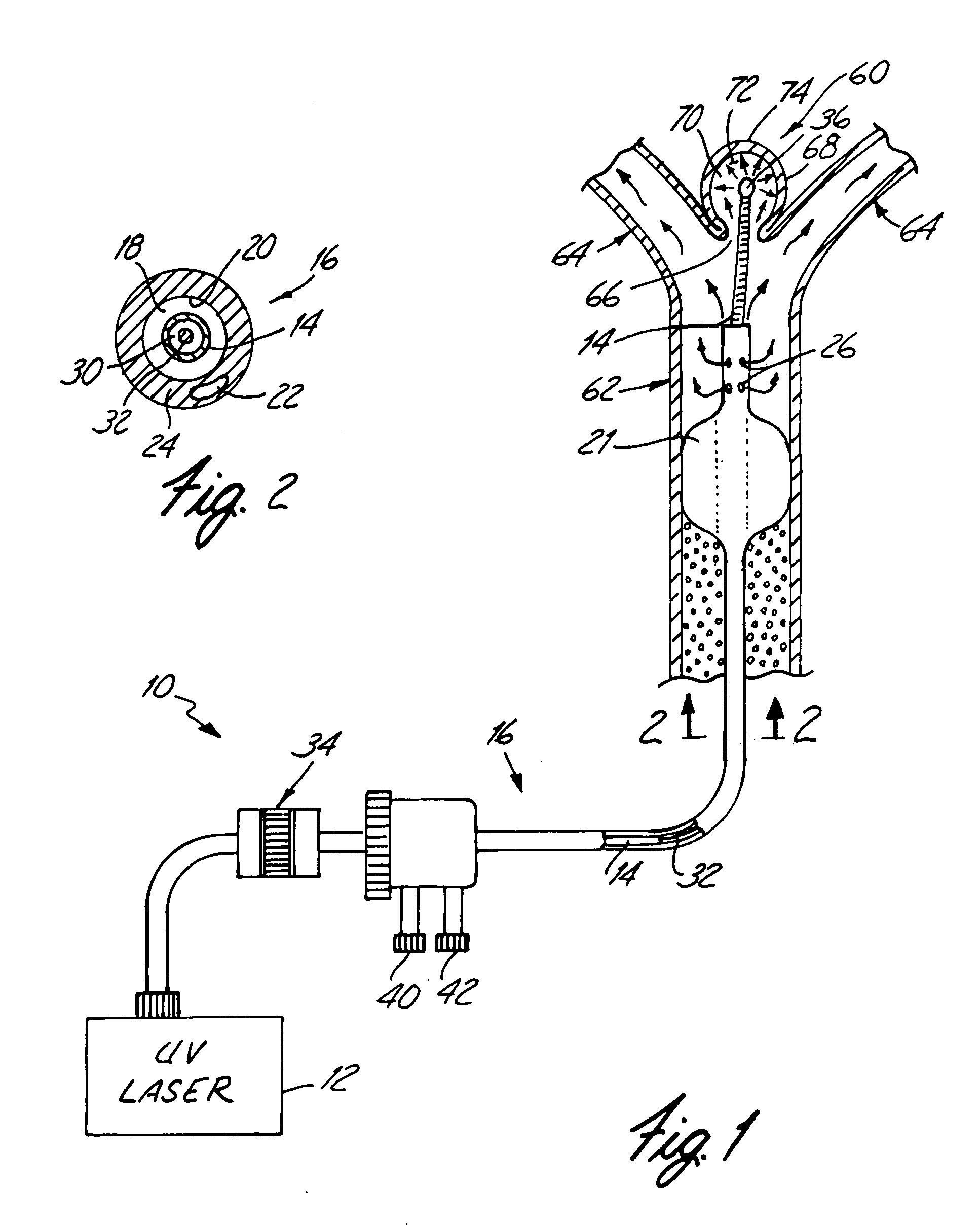 Apparatus and method for treatment of cerebral aneurysms, arterial-vascular malformations and arterial fistulas