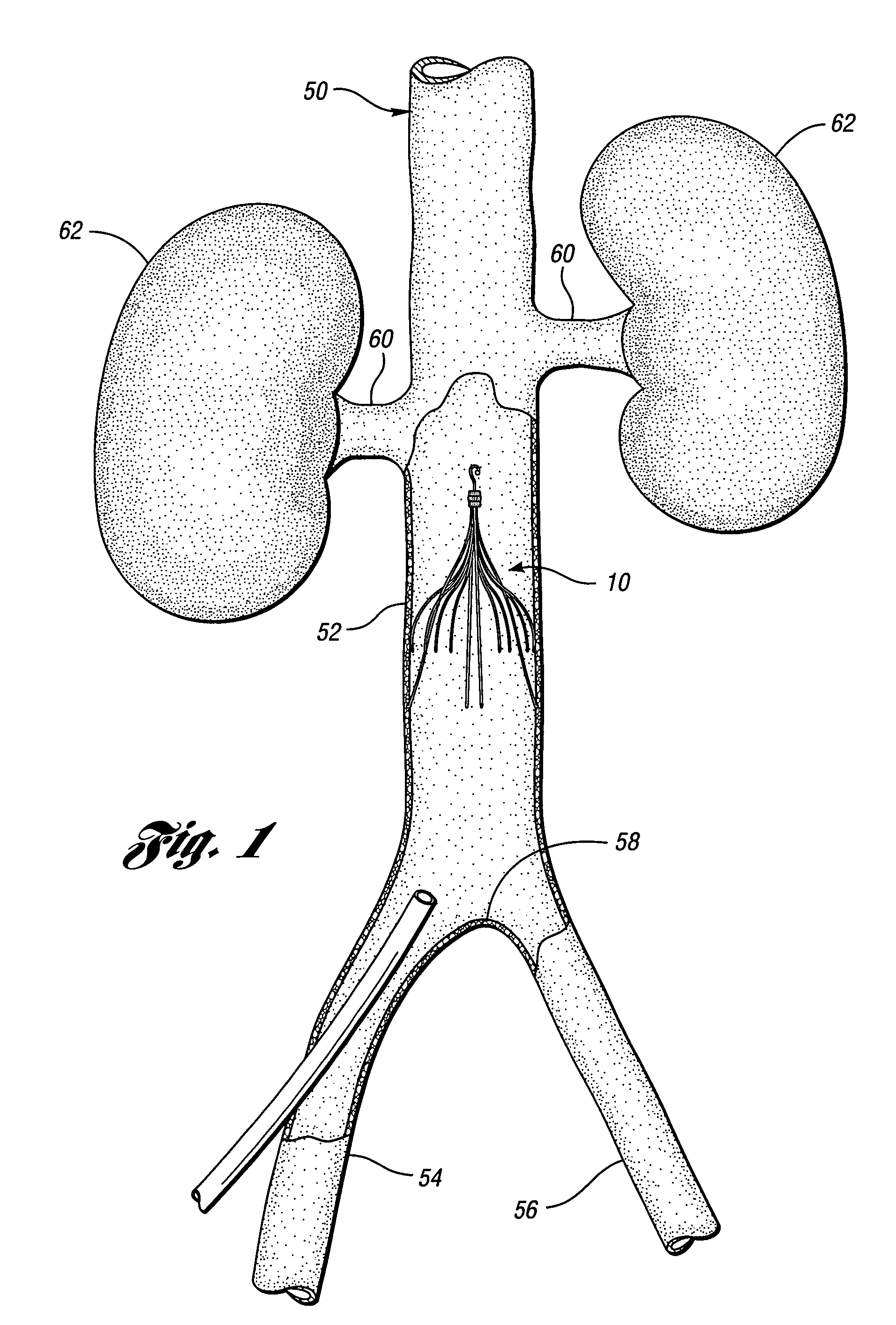 Removable vena cava filter comprising struts having axial bends