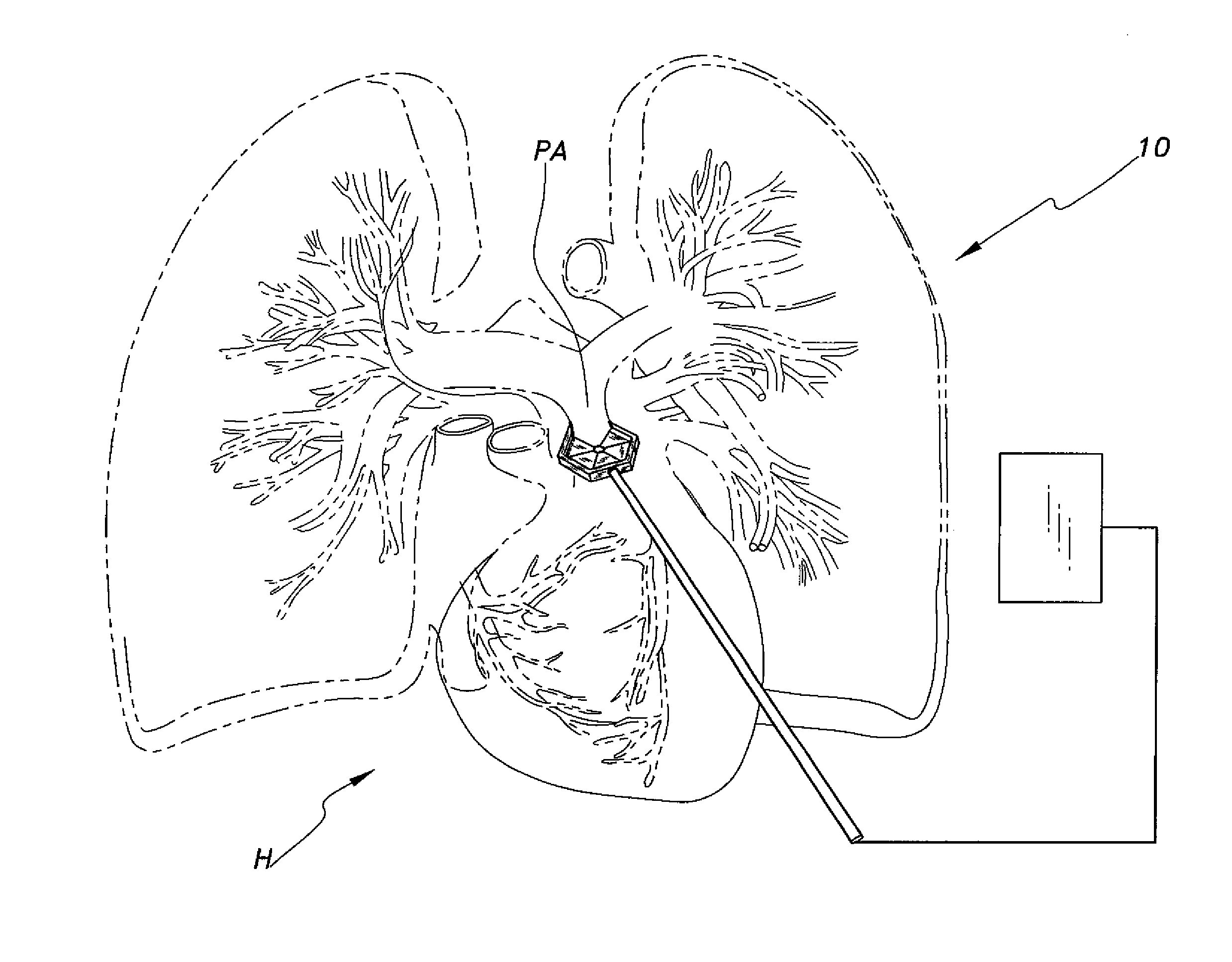 Minimally invasive pulmonary artery band