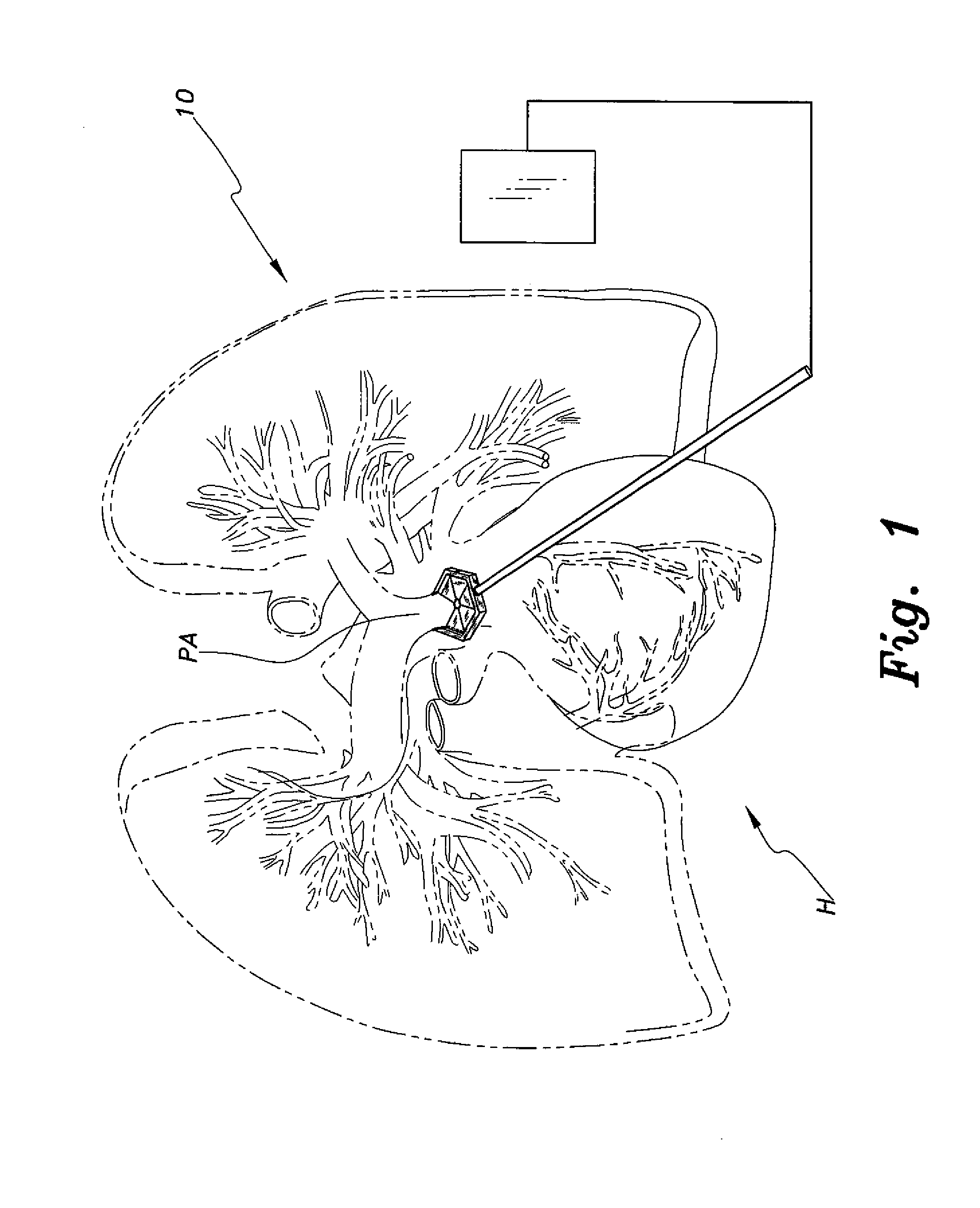 Minimally invasive pulmonary artery band