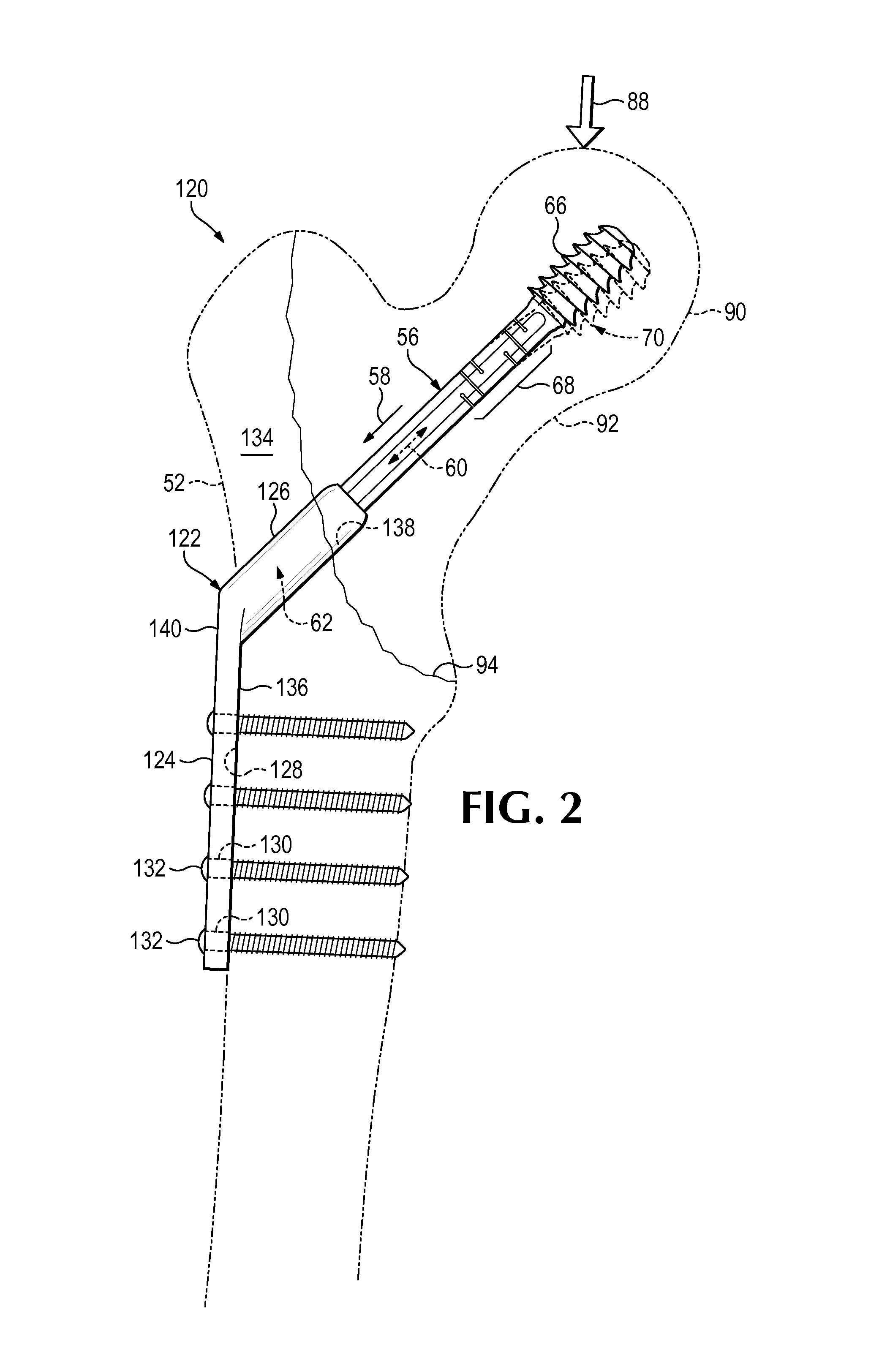 Hip fixation system with a compliant fixation element