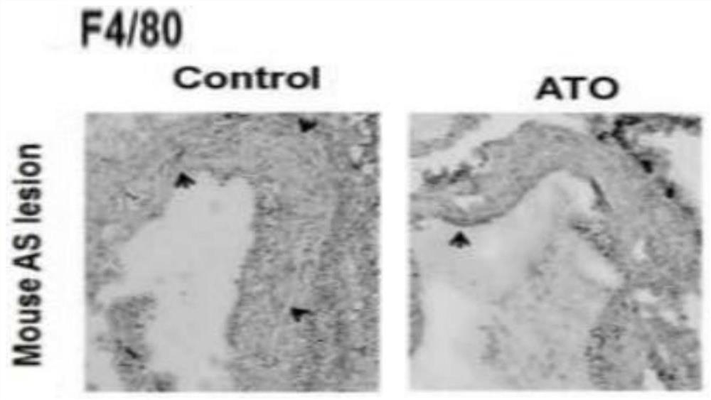 Use of arsenic trioxide in the preparation of drugs for treating advanced atherosclerosis