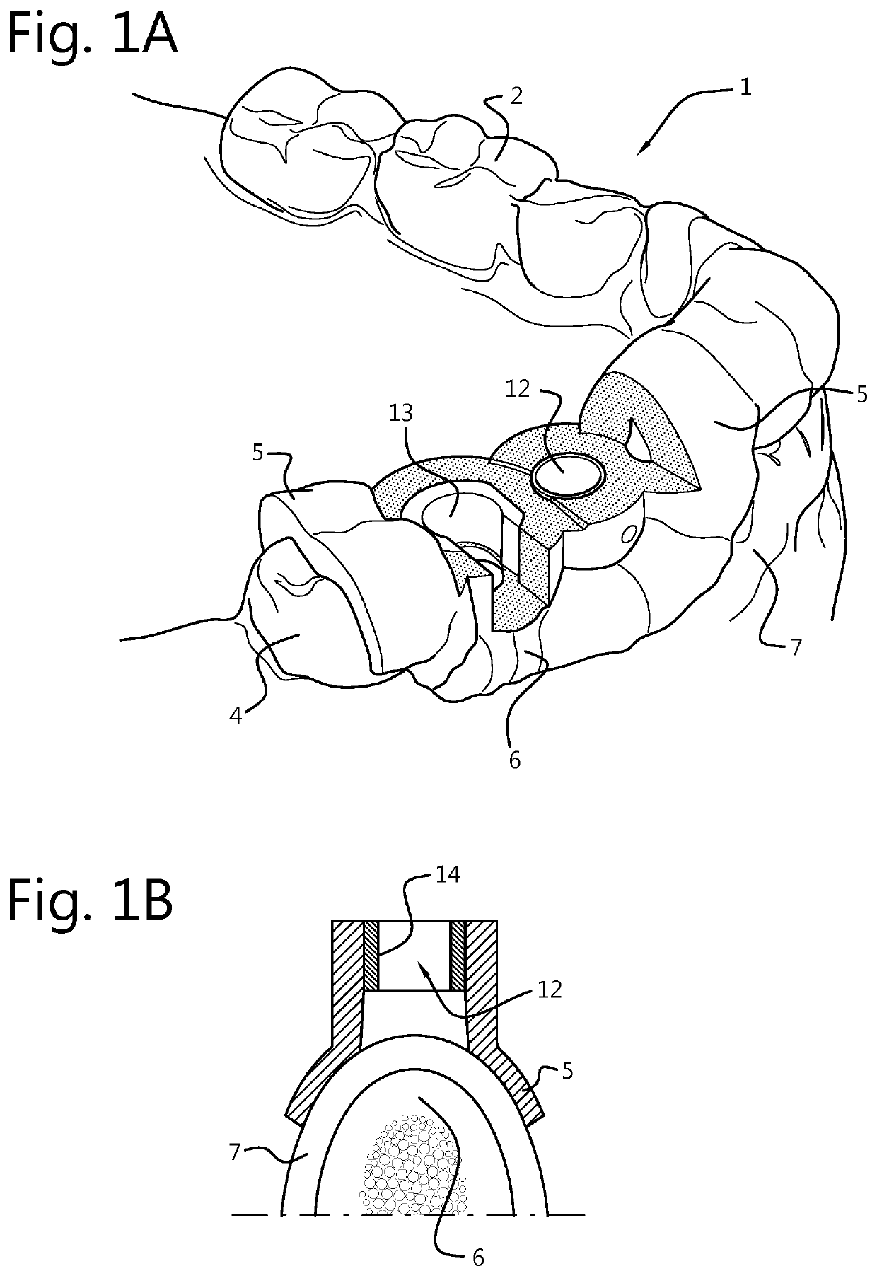 Force-closure or form-closure positioning of surgical templates for guided implant dentistry