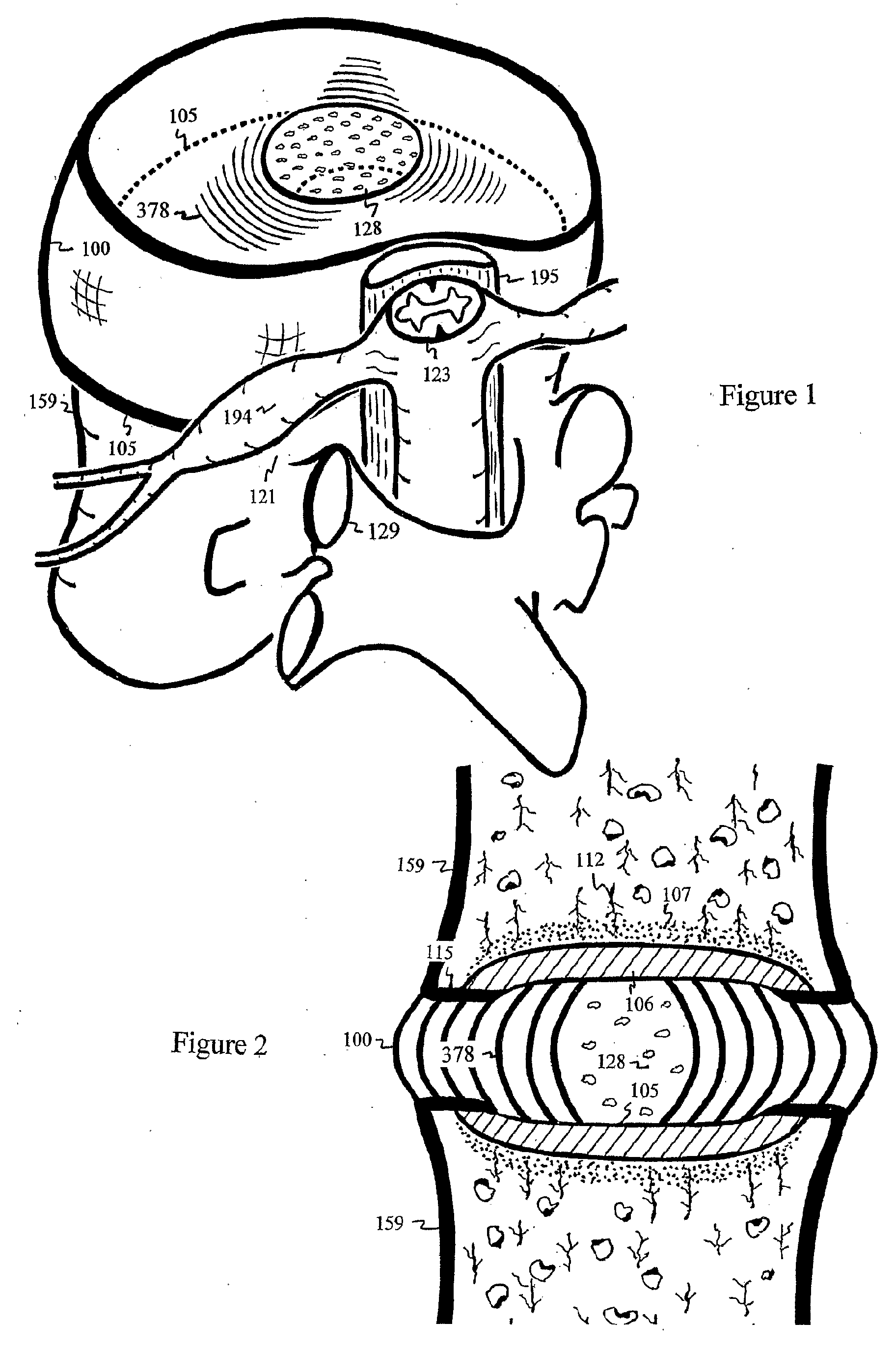 Injection device for the intervertebral disc