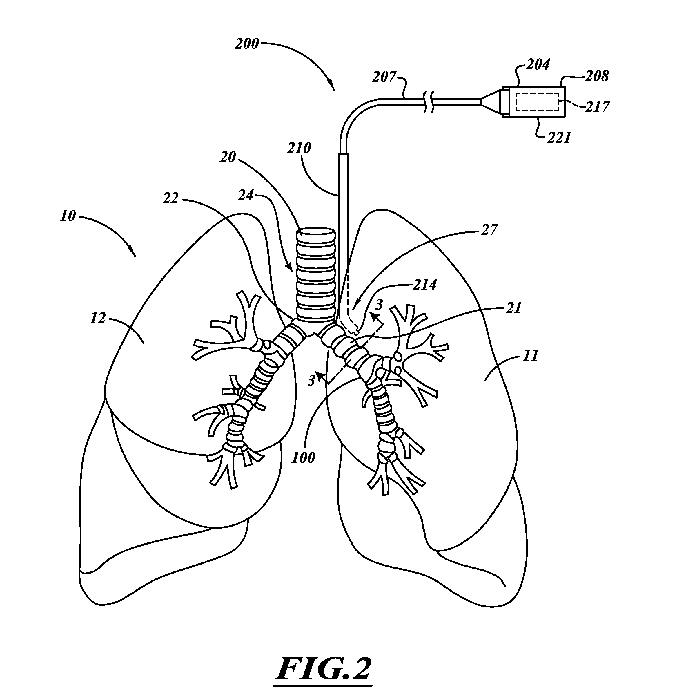 Non-invasive and minimally invasive denervation methods and systems for performing the same