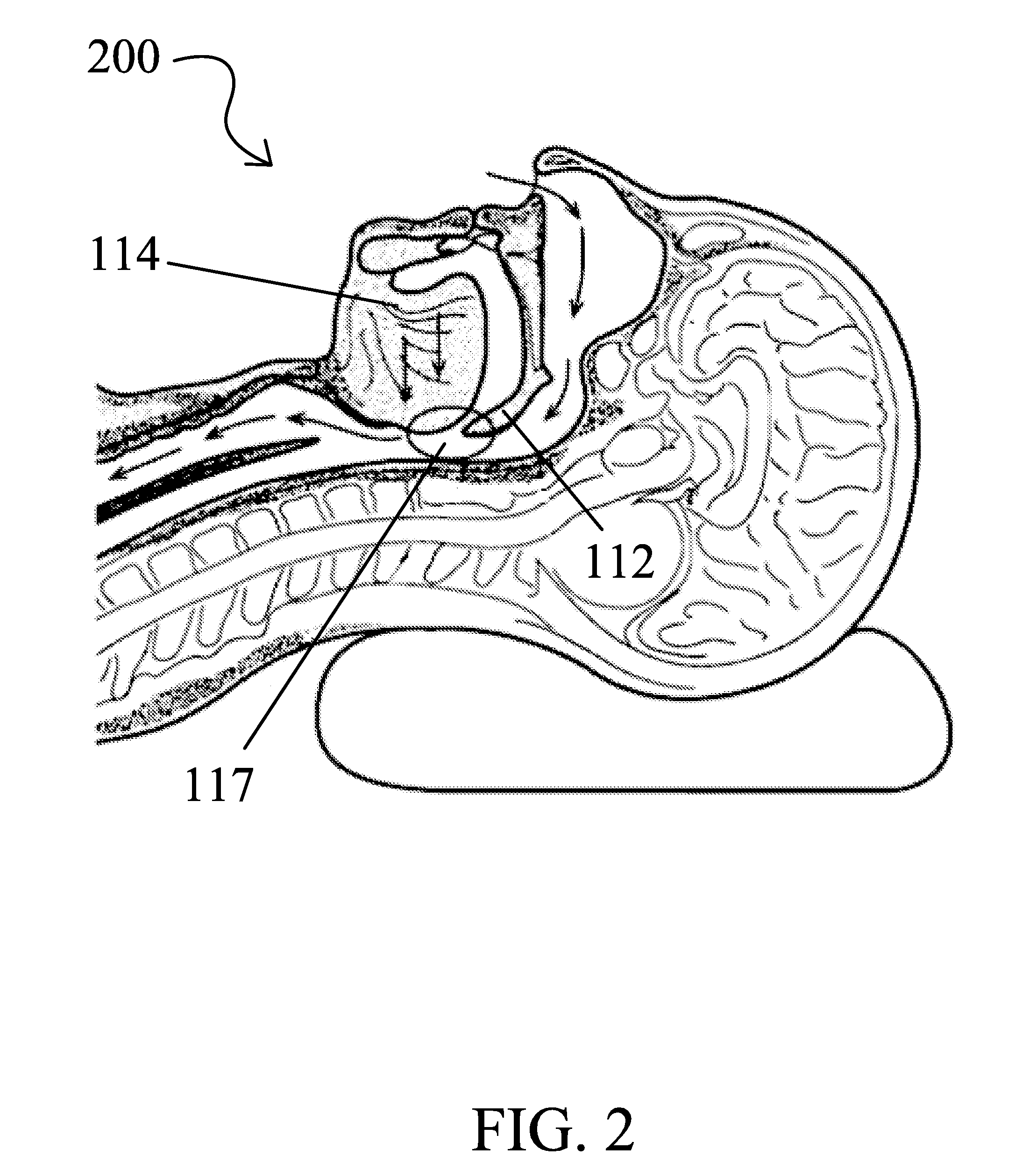 Snoring and obstructive sleep apnea prevention and treatment device