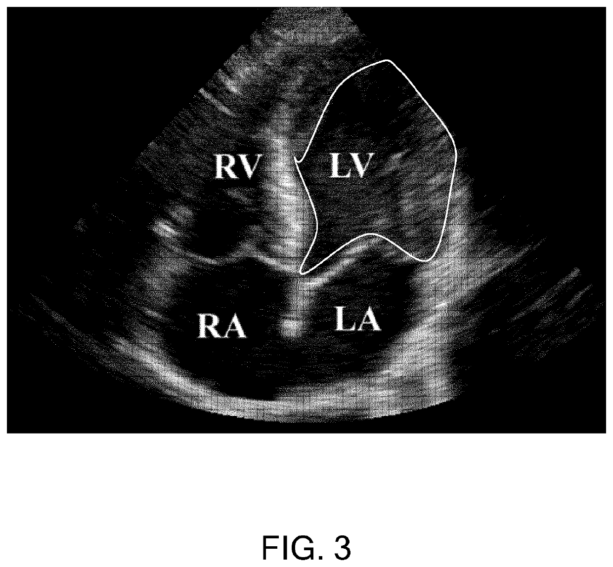 Anatomical measurements from ultrasound data