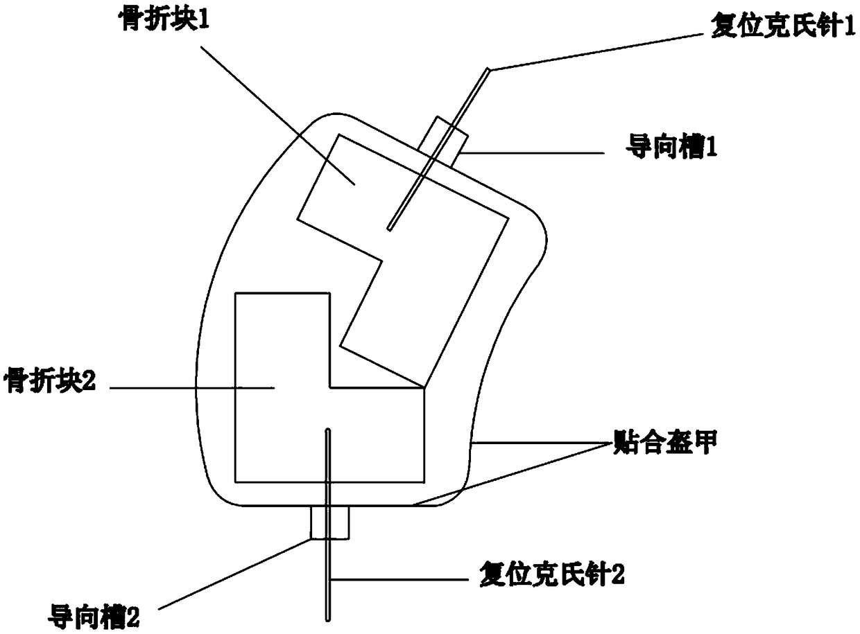 Calcaneal-fracture-closed-reduction-internal-fixation assisting method based on digitized 3D printing tool