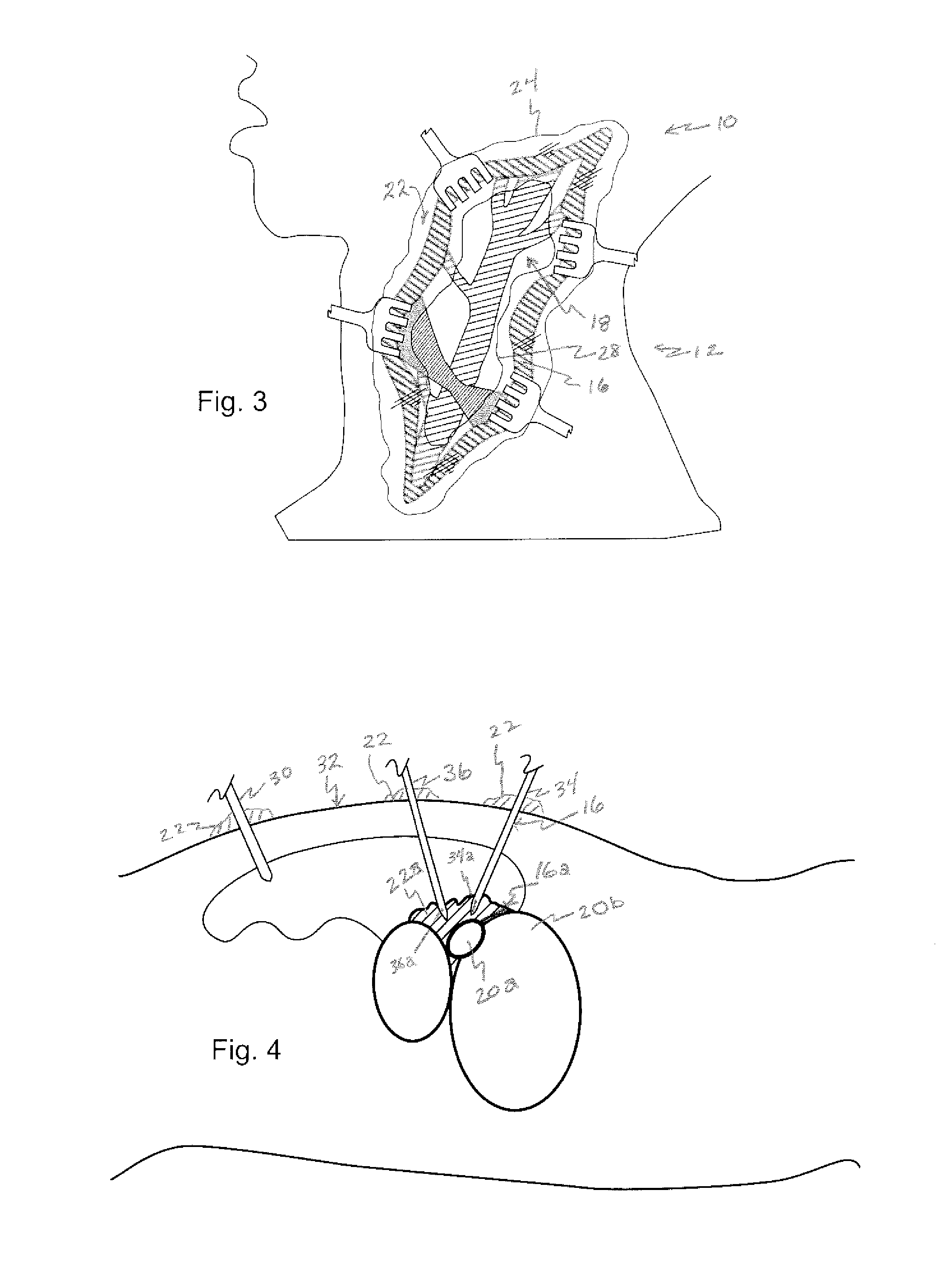 Method of inhibiting the formation of adhesions and scar tissue and reducing blood loss