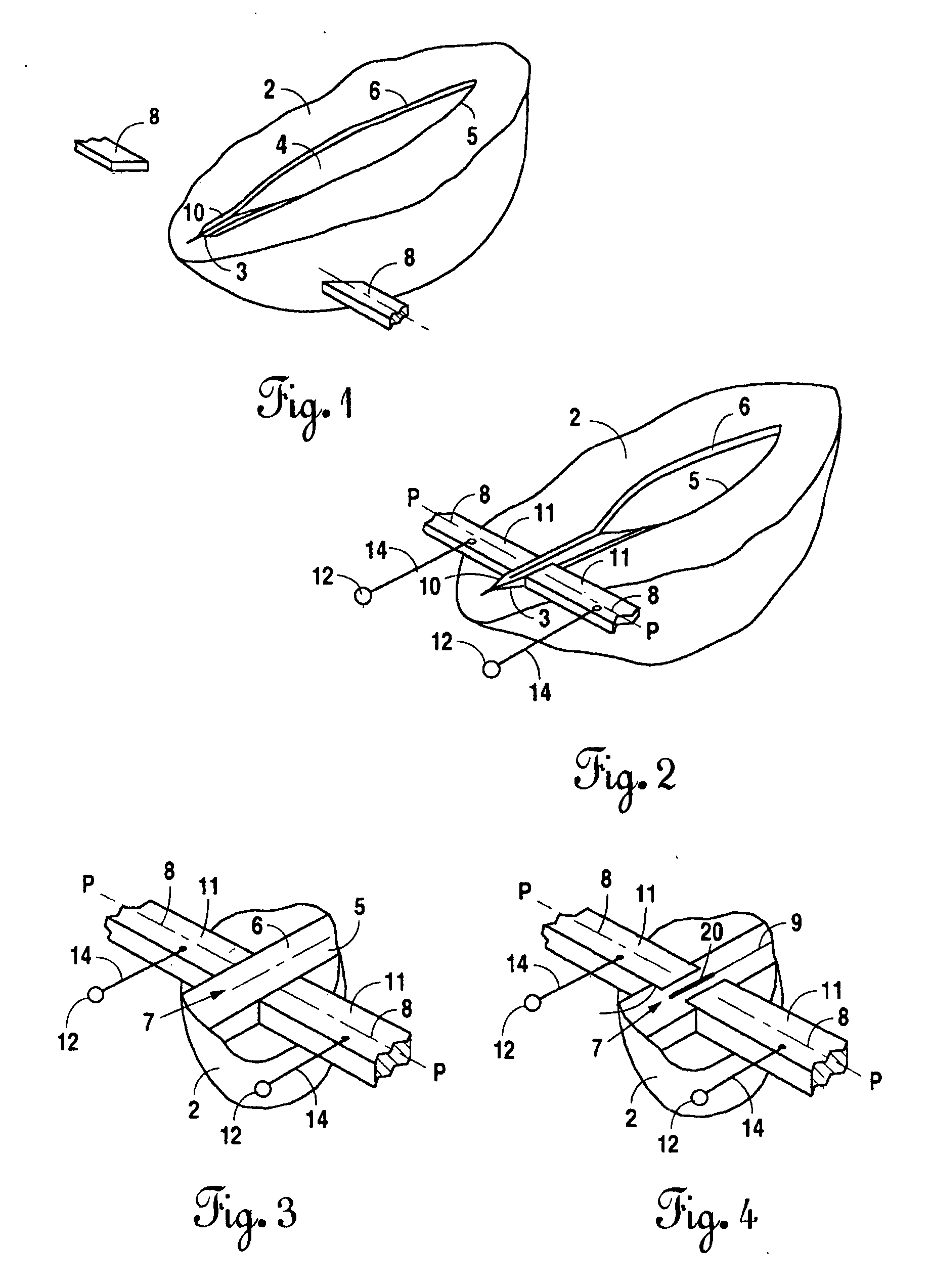 Instrument and method for the end-to-end reconnection of intestinal tissues