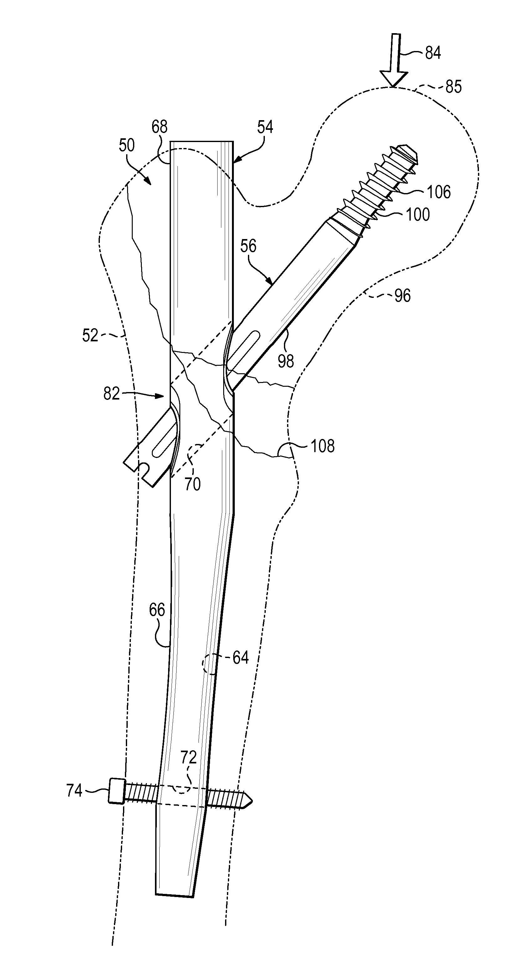 Nail-based compliant hip fixation system