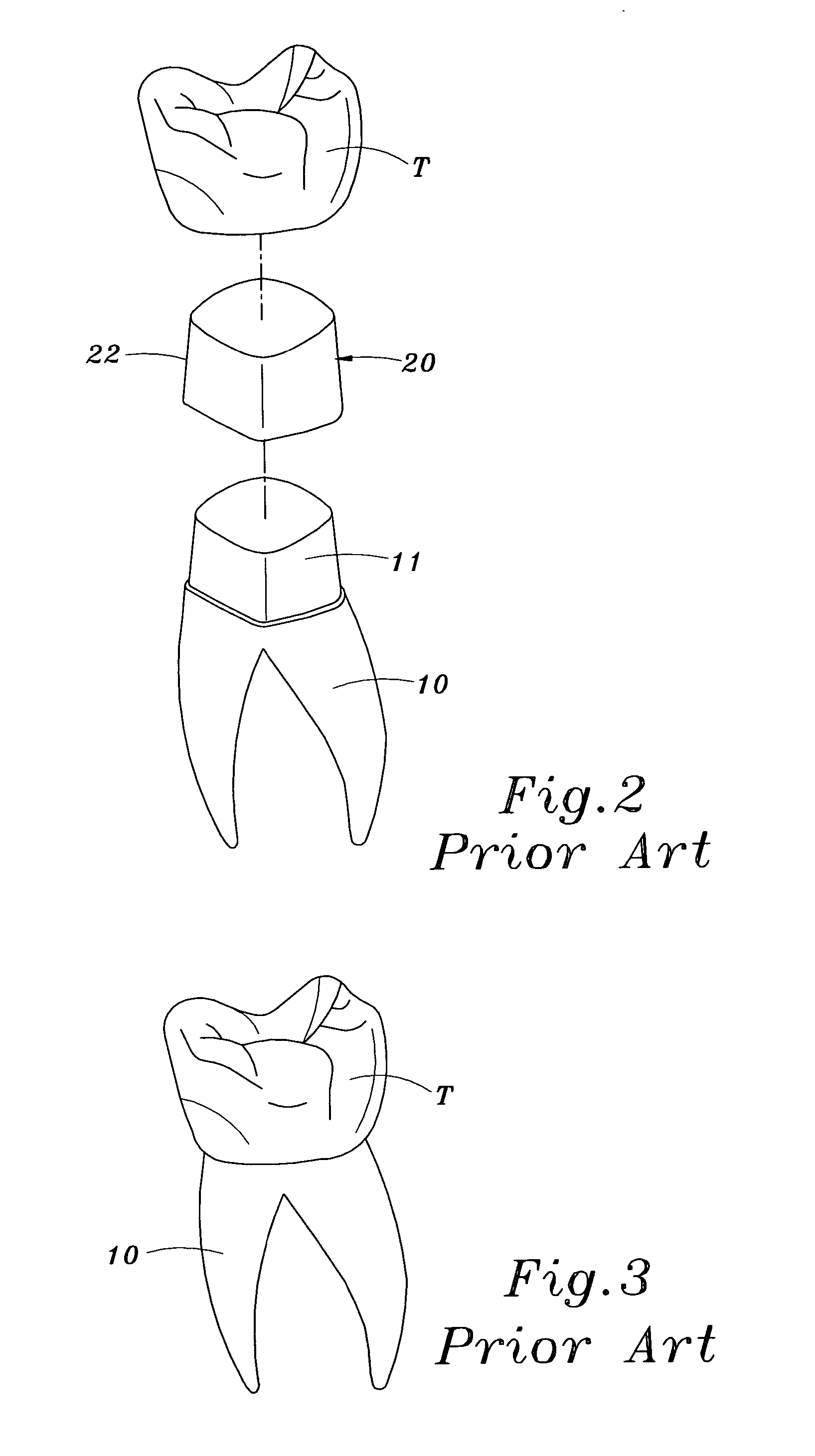 Method of mounting removable restoration tooth by using a standardized set of inner crown units, outer crown units, and device units for conforming abutment