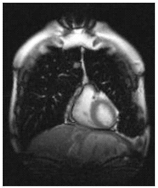 Heart magnetic resonance imaging (MRI) image deblurring method based on sparse low rank and dictionary learning