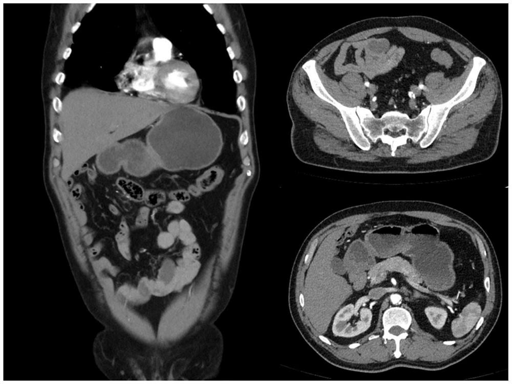 Traditional Chinese medicine composition for abdominal enhancement as well as preparation method and application of traditional Chinese medicine composition