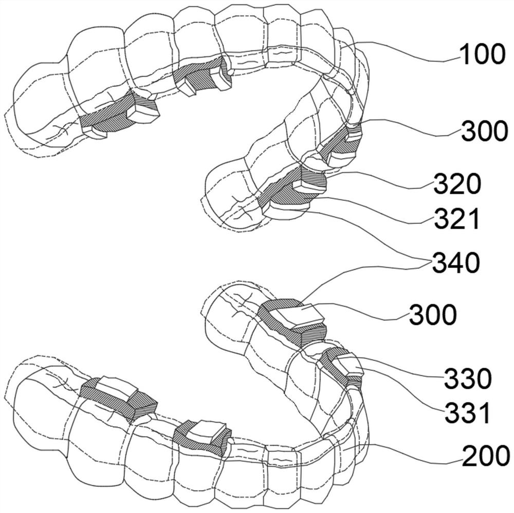 Bracket-free invisible orthodontic vertical control device used after orthognathic operation