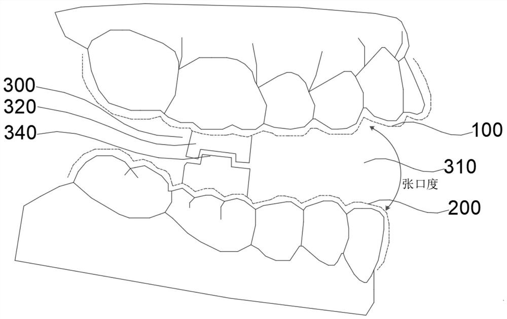 Bracket-free invisible orthodontic vertical control device used after orthognathic operation