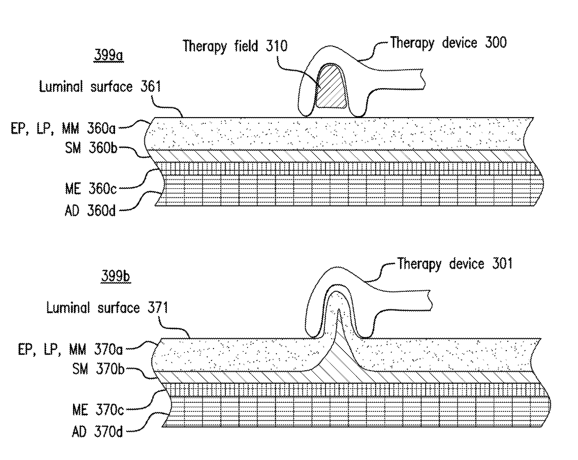 Systems, devices, apparatus and method devices for providing endoscopic mucosal therapy