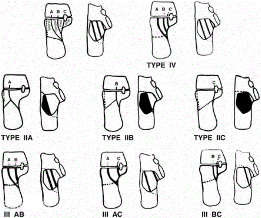 Calcaneal intramedullary fixation system and auxiliary placement instruments