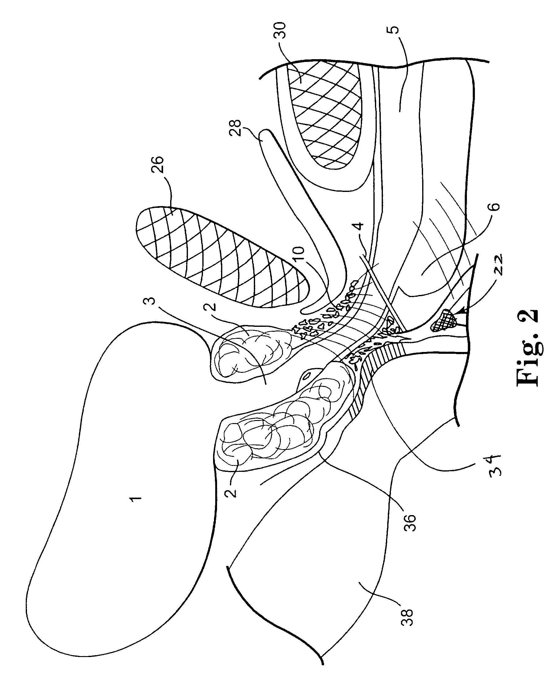Transobturator methods for installing sling to treat incontinence, and related devices