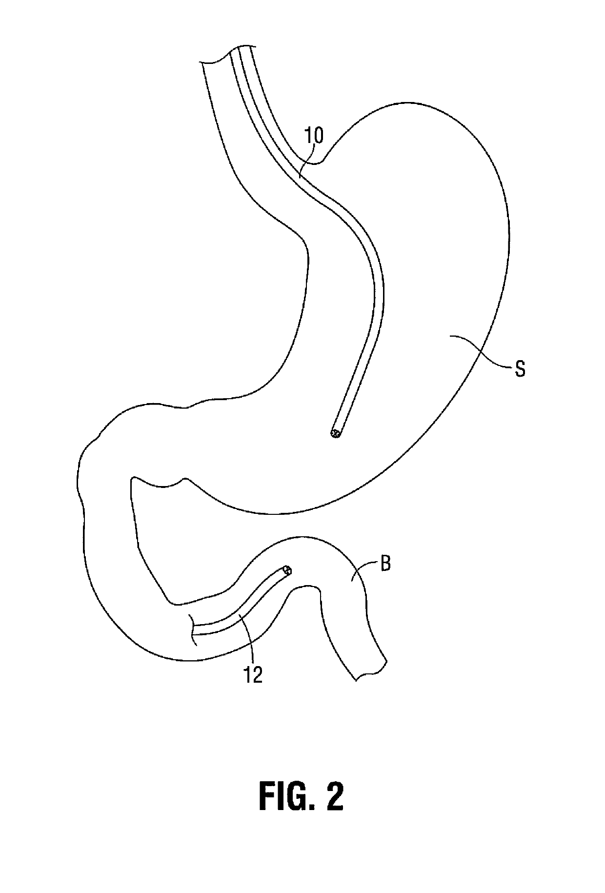 Gastric bypass system and method