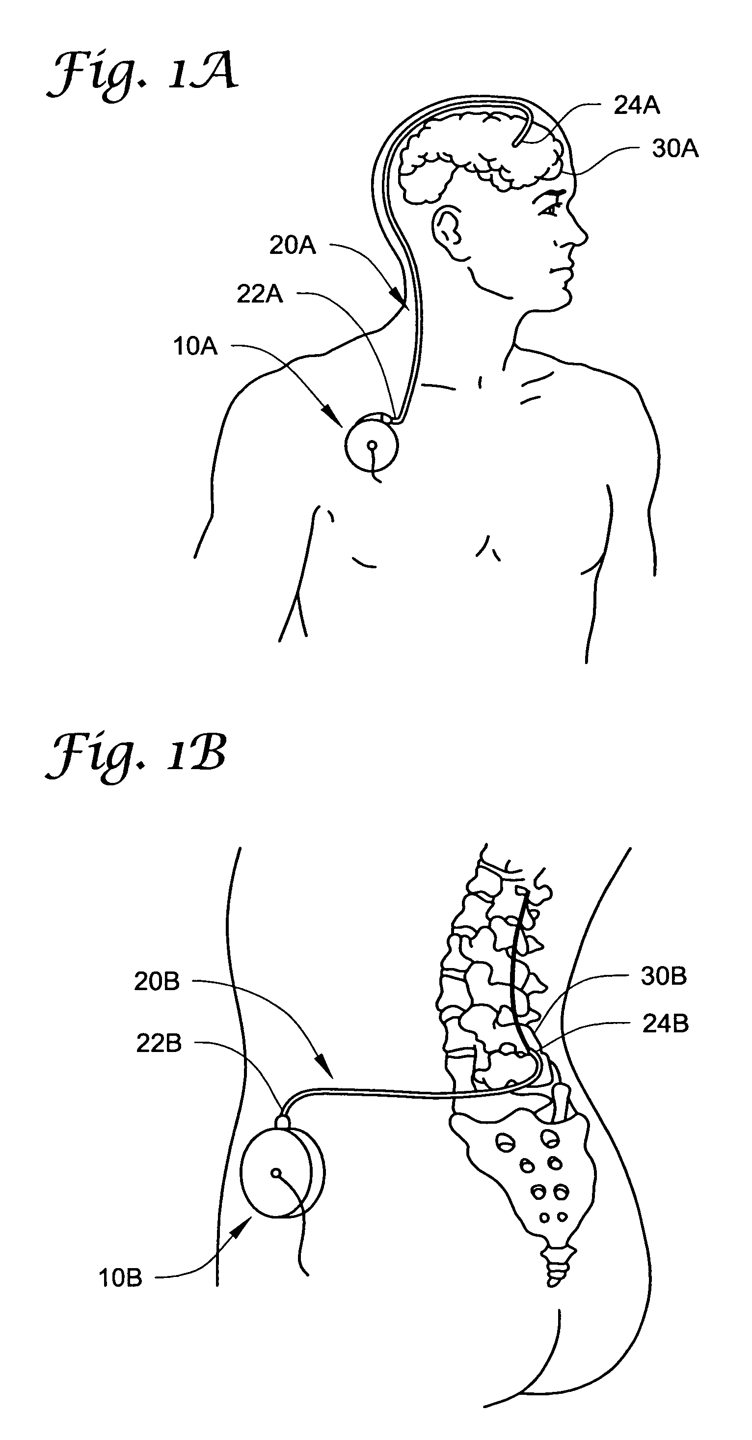 Reduction of inflammatory mass with spinal catheters