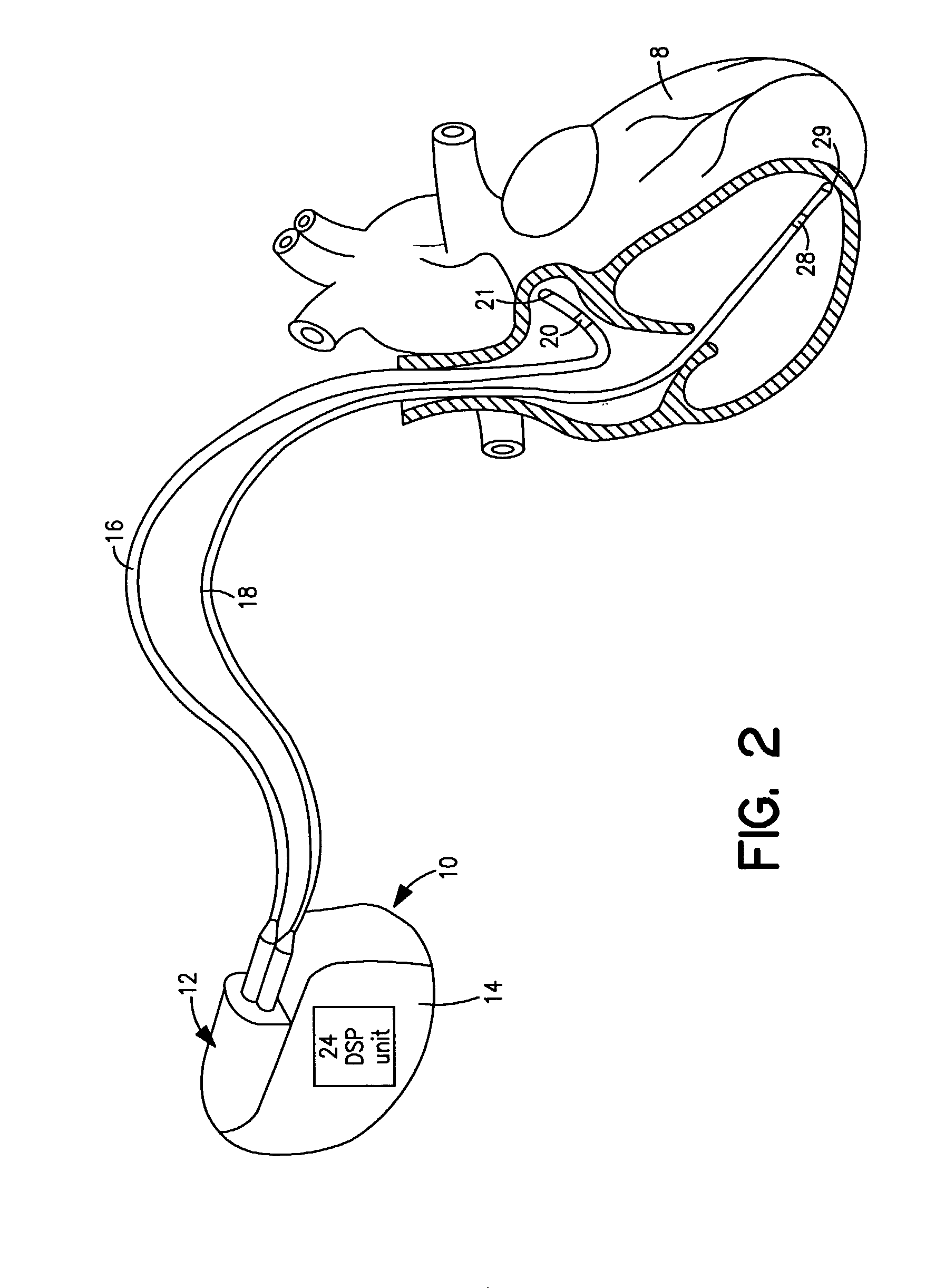 Method and system for compressing and storing data in a medical device having limited storage